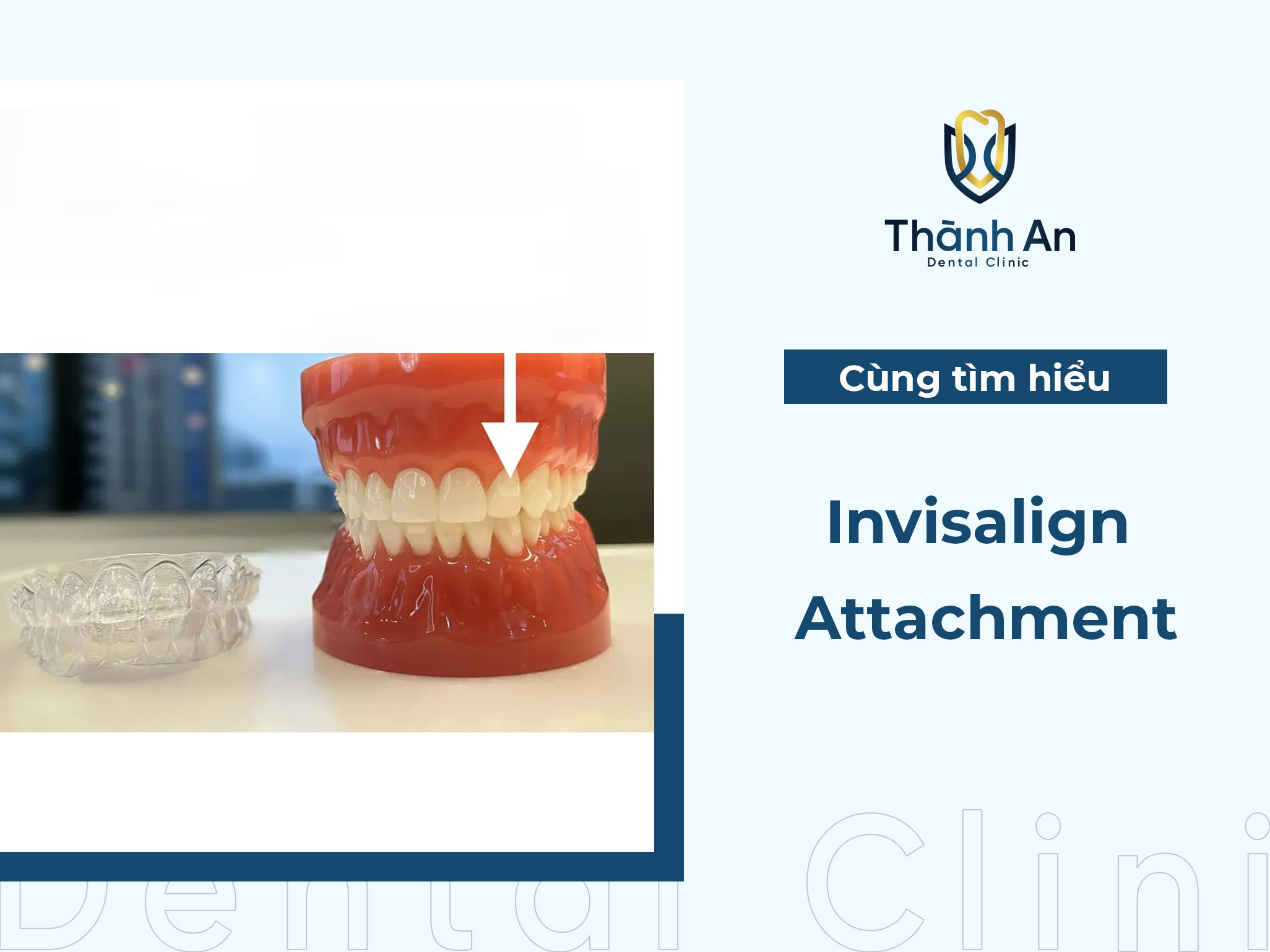 Invisalign Attachment - Công nghệ nâng cao hiệu quả niềng răng