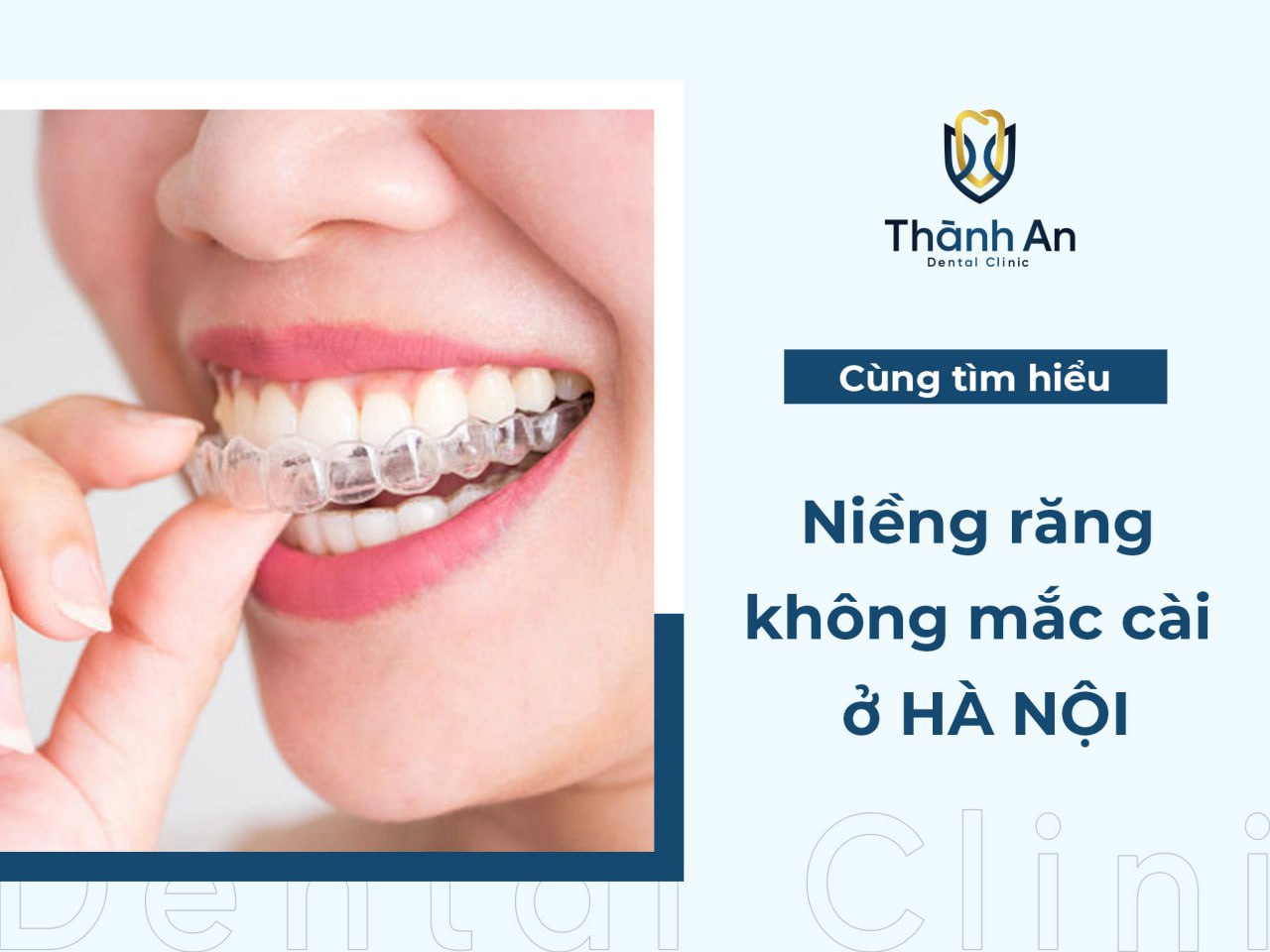 Niềng răng không mắc cài ở Hà Nội giá bao nhiêu?