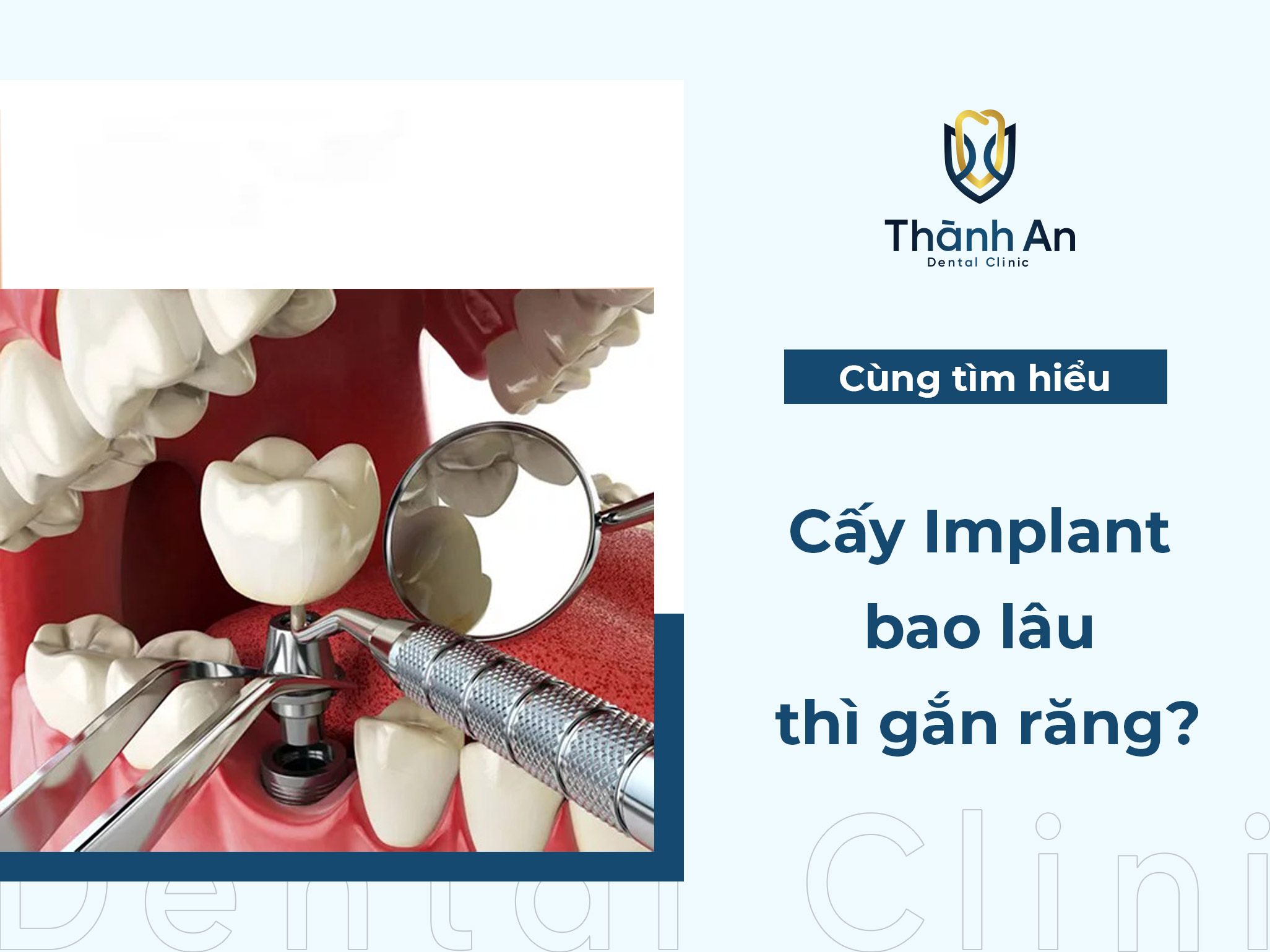 Cấy implant bao lâu thì gắn răng?