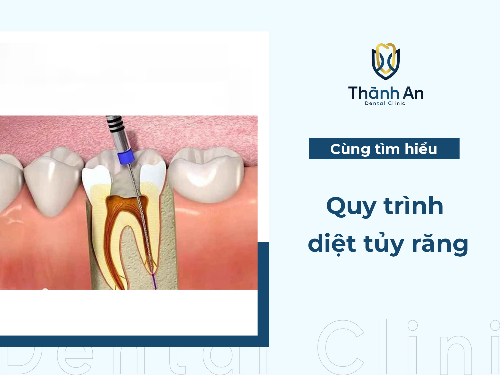 Tìm hiểu quy trình diệt tủy răng không đau, an toàn và giá rẻ