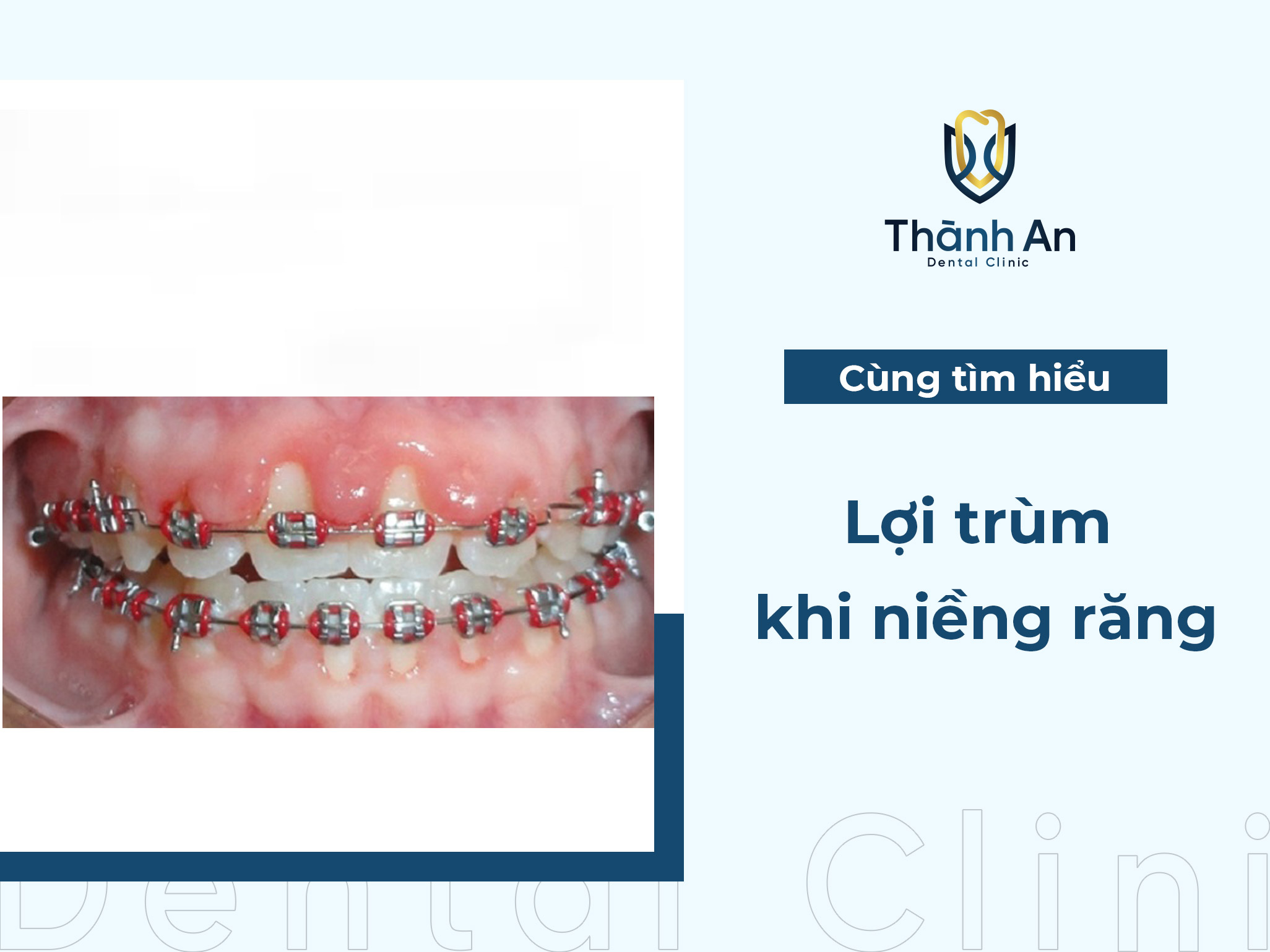 Lợi trùm khi niềng răng: Nguyên nhân, triệu chứng và cách khắc phục