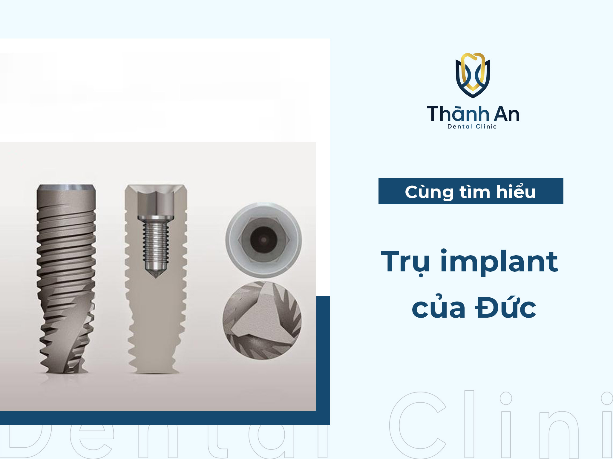 Trụ Implant Đức có mấy loại? Nên trồng loại nào?