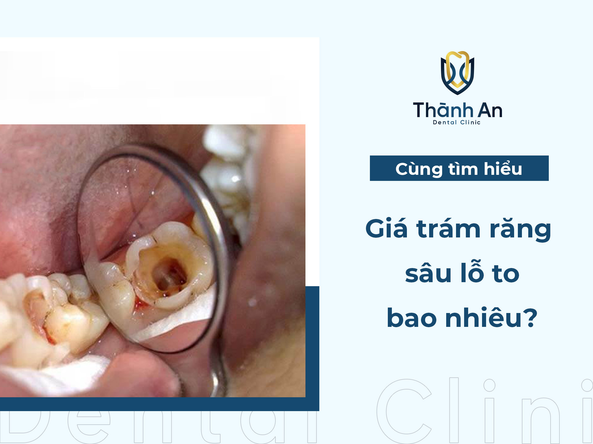 Trám răng sâu lỗ to bao nhiêu tiền? Hiệu quả không