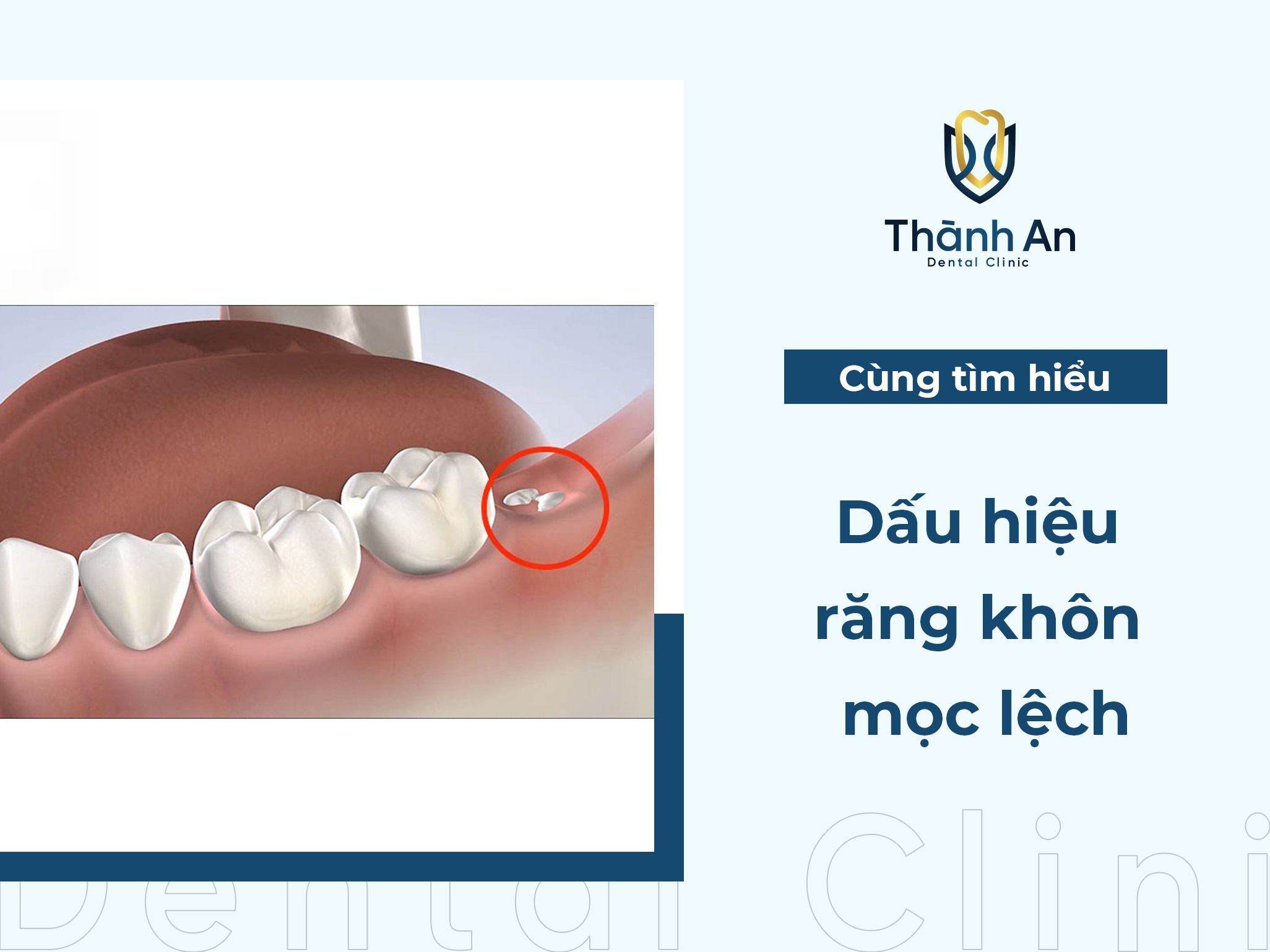 Dấu hiệu răng khôn mọc lệch | Cách nhận biết và phương pháp khắc phục chuẩn y khoa