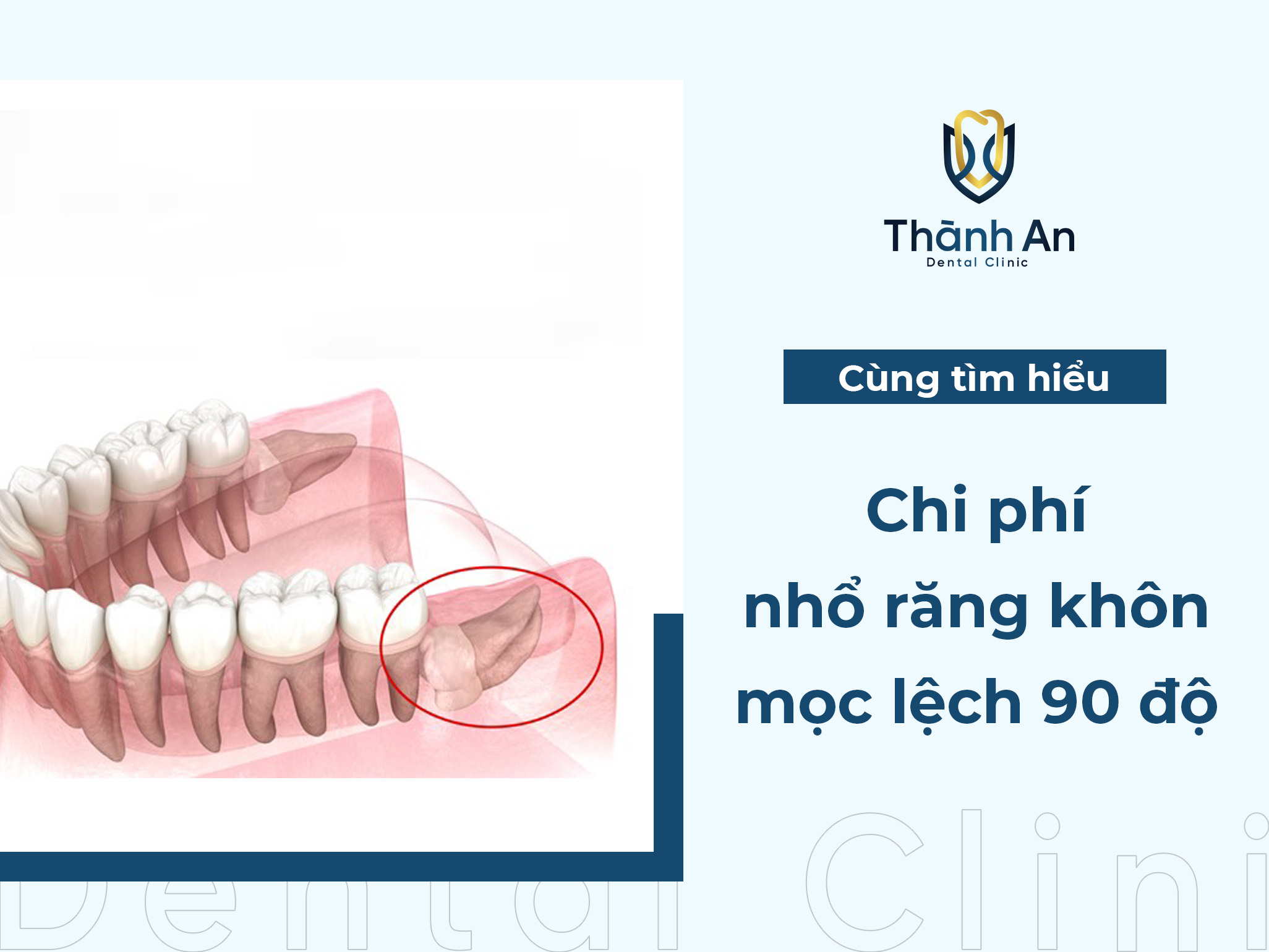 Chi phí nhổ răng khôn mọc lệch 90 độ là bao nhiêu tiền? Bảng giá 2024