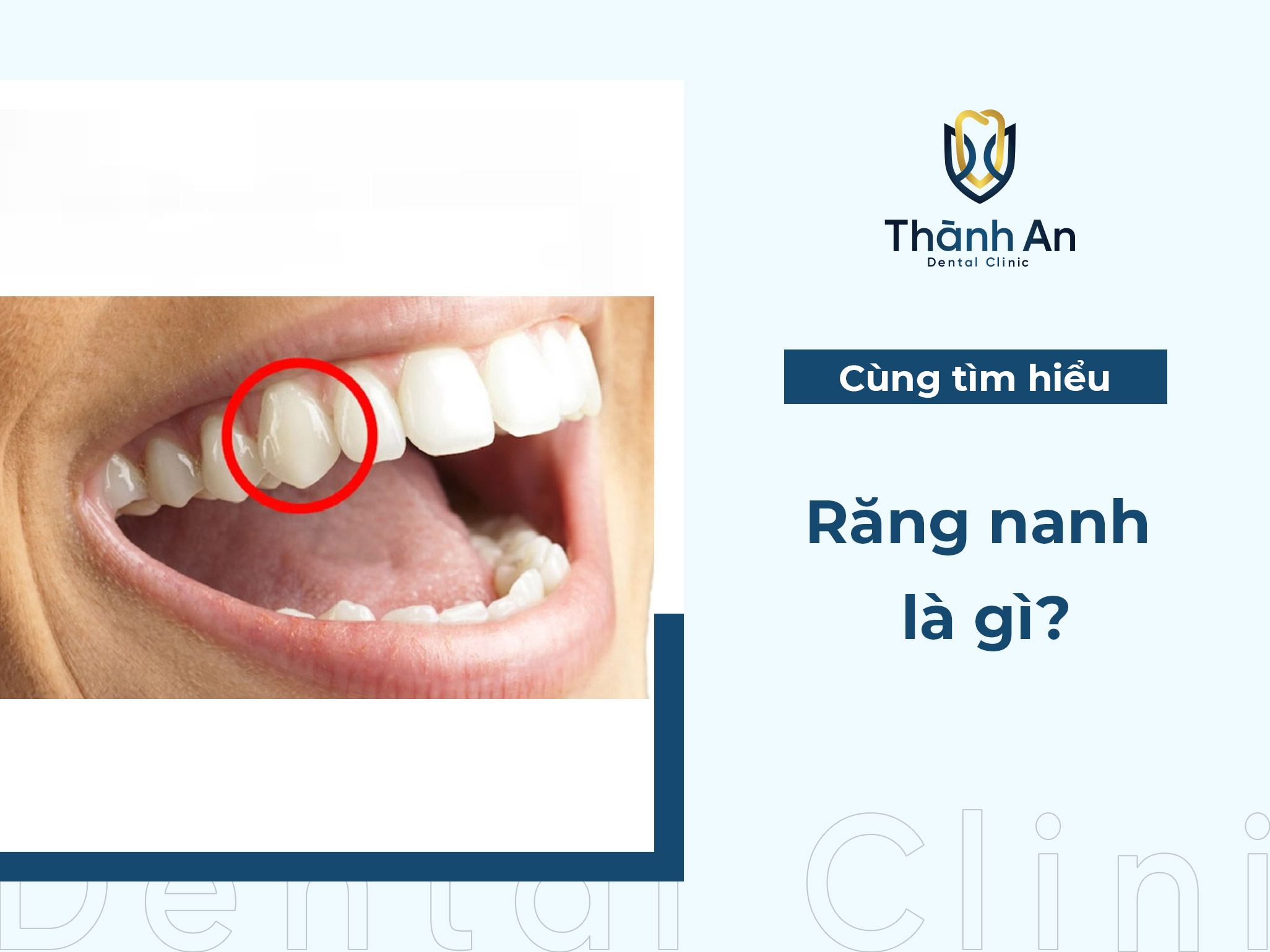 Răng nanh là gì? Đặc điểm và cách sở hữu răng nanh đẹp