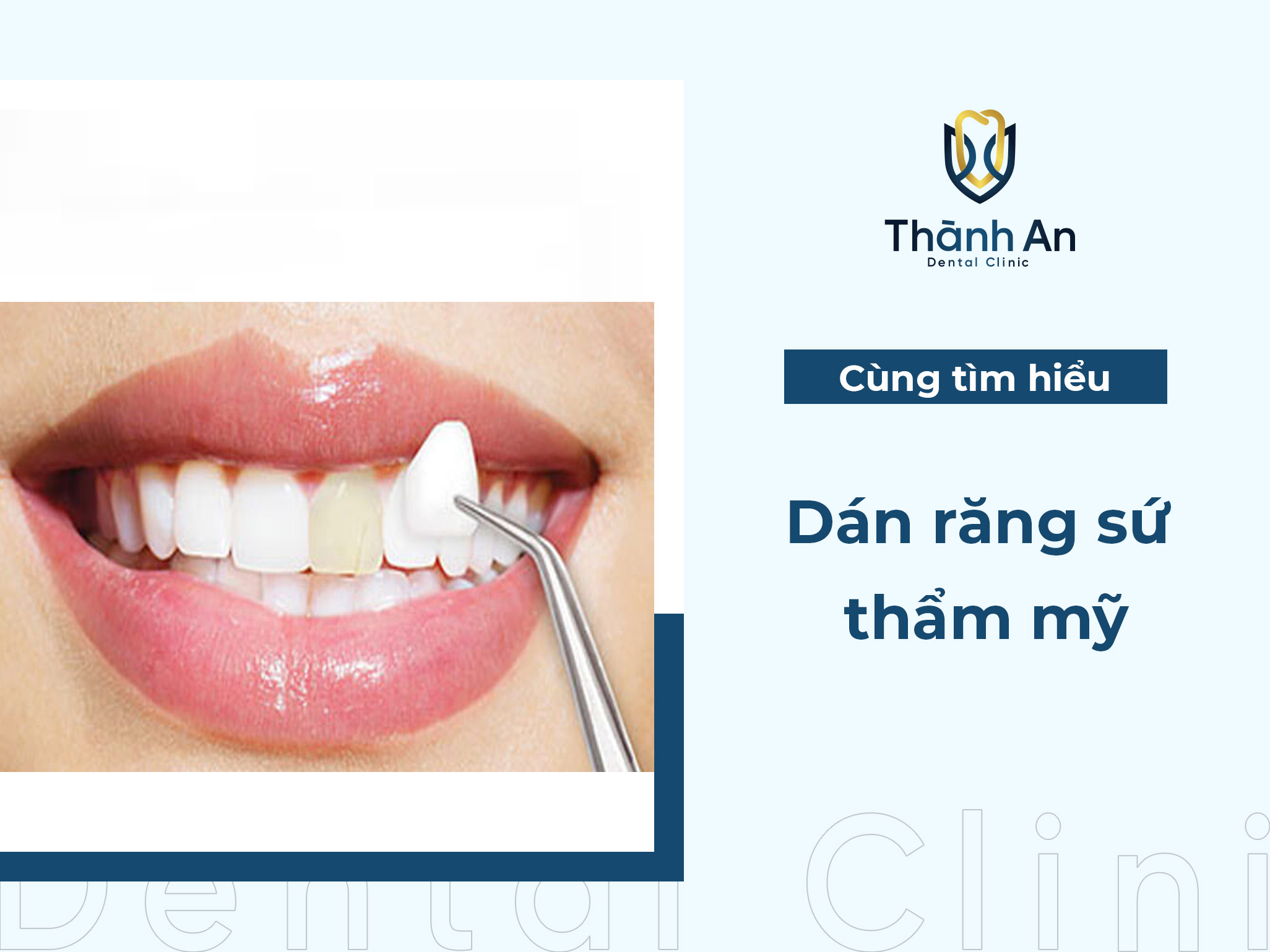 Dán răng sứ thẩm mỹ là gì? So sánh bọc răng sứ và dán răng sứ