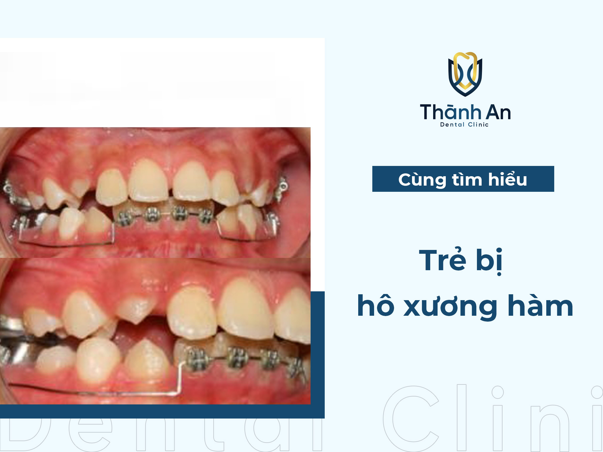 Trẻ bị hô xương hàm: Dấu hiệu, nguyên nhân và hướng điều trị