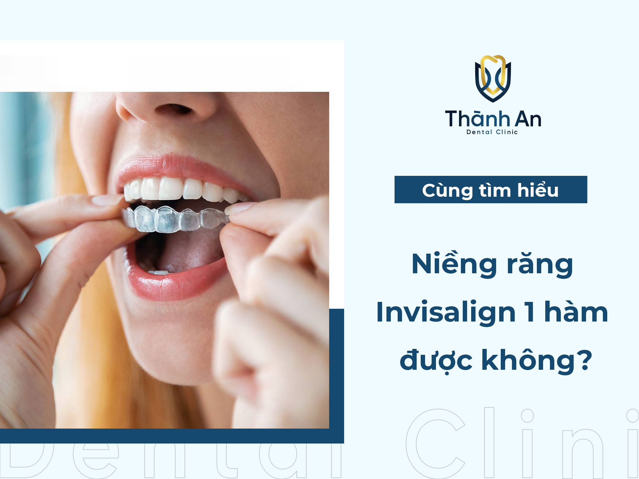[Hỏi - Đáp] Niềng răng invisalign 1 hàm có được không?