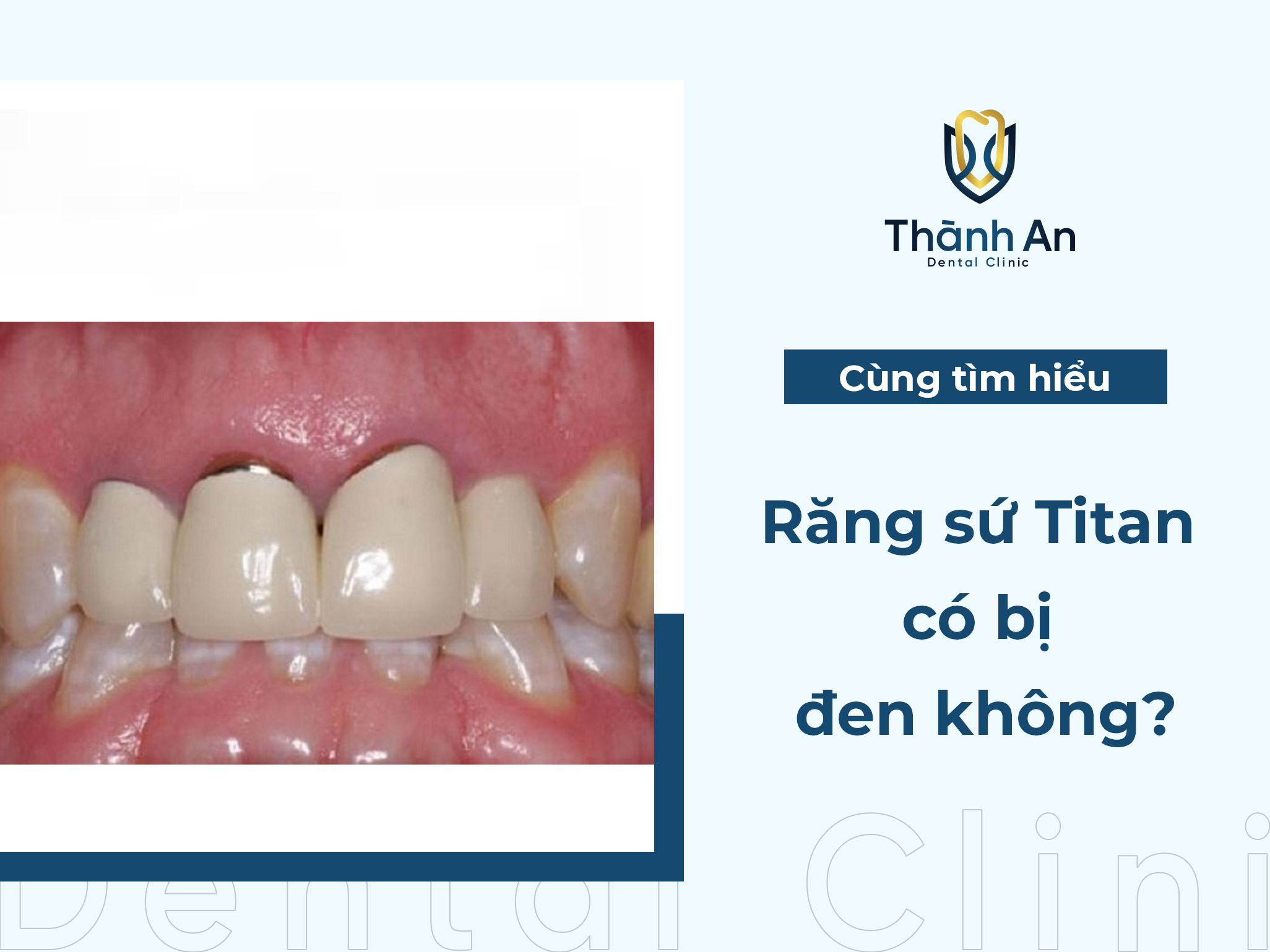 [Hỏi - Đáp] Răng sứ Titan có bị đen không?