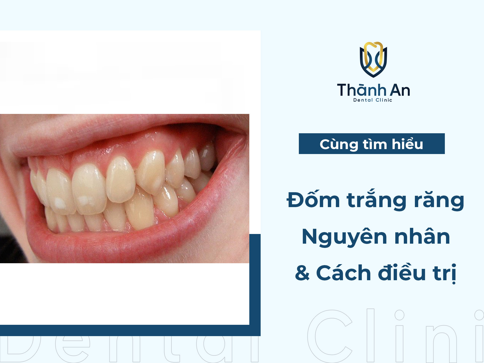 Răng có đốm trắng: Nguyên nhân và cách điều trị & phòng ngừa
