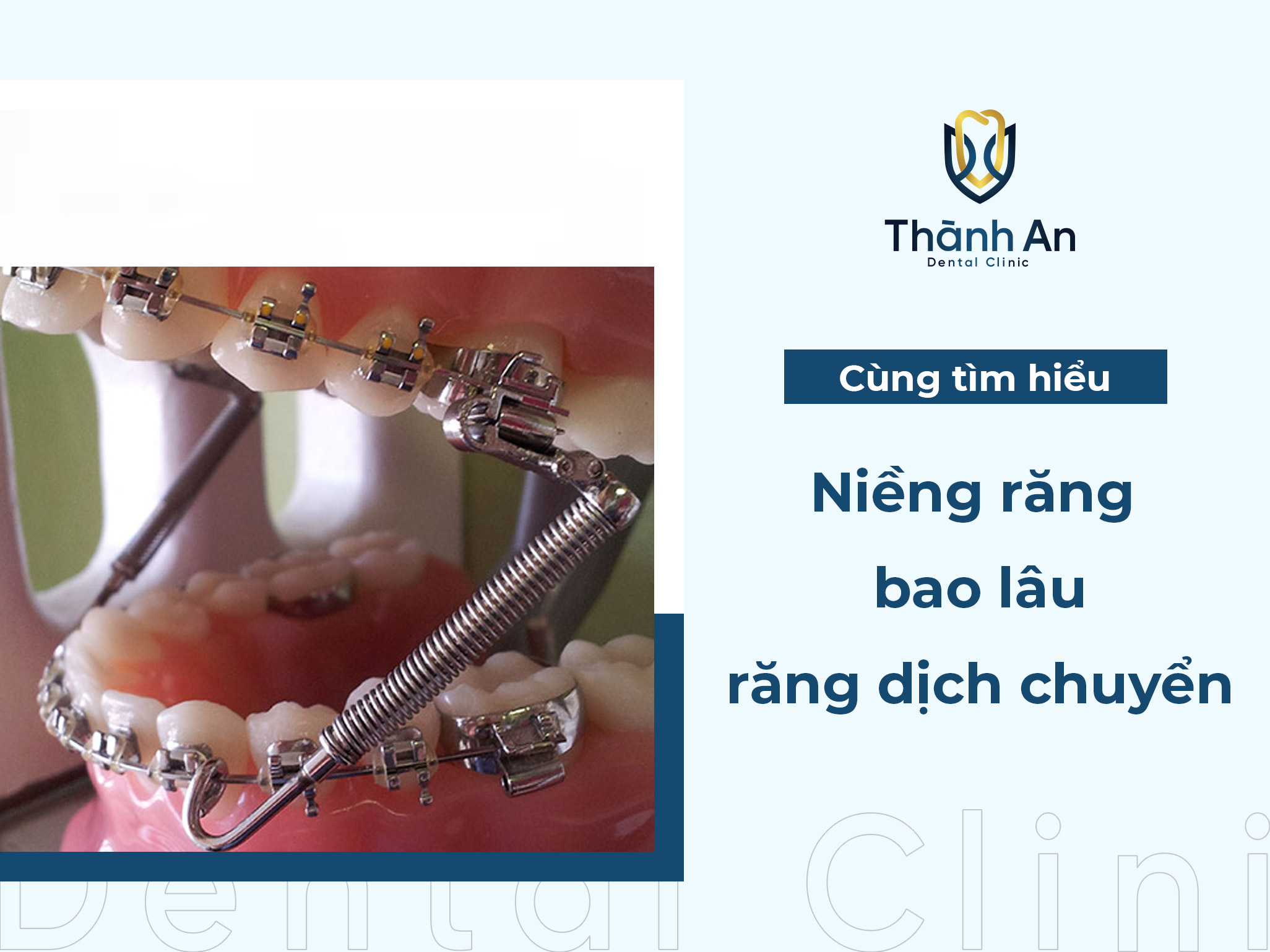 Niềng răng bao lâu thì răng bắt đầu dịch chuyển?