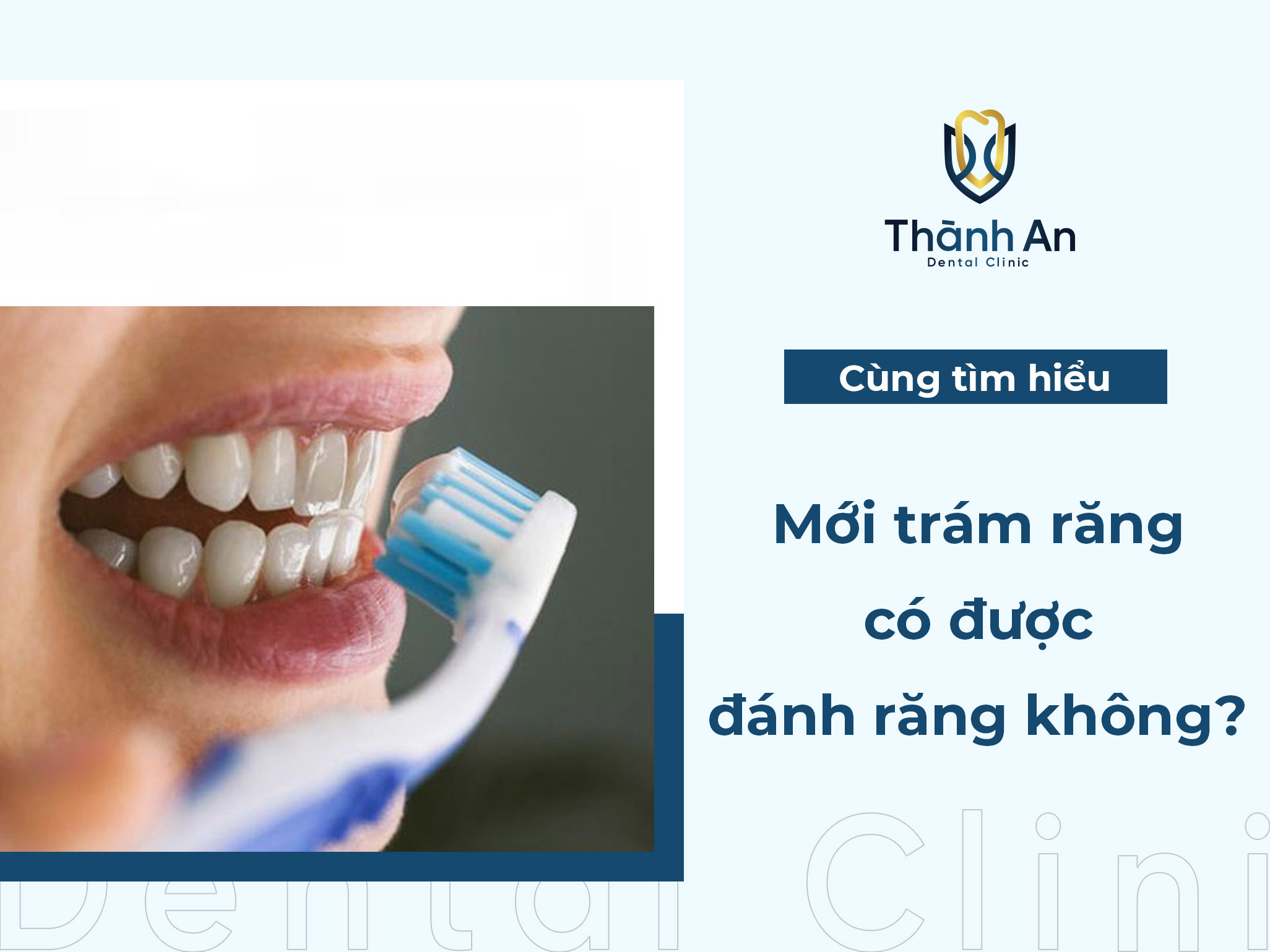 Mới trám răng có được đánh răng không?  chia sẻ từ Bác Sỹ