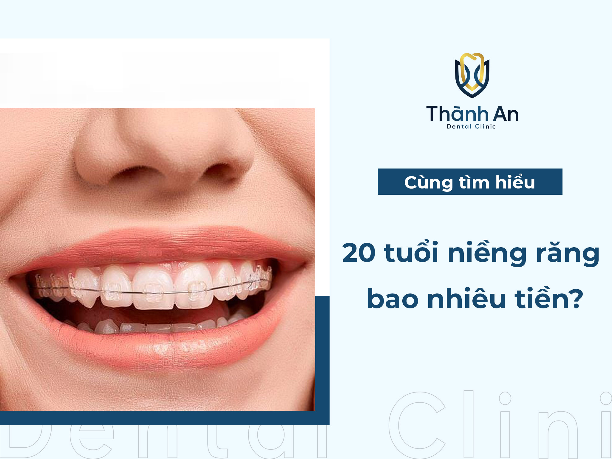 20 tuổi niềng răng bao nhiêu tiền? Phương pháp niềng nào phù hợp