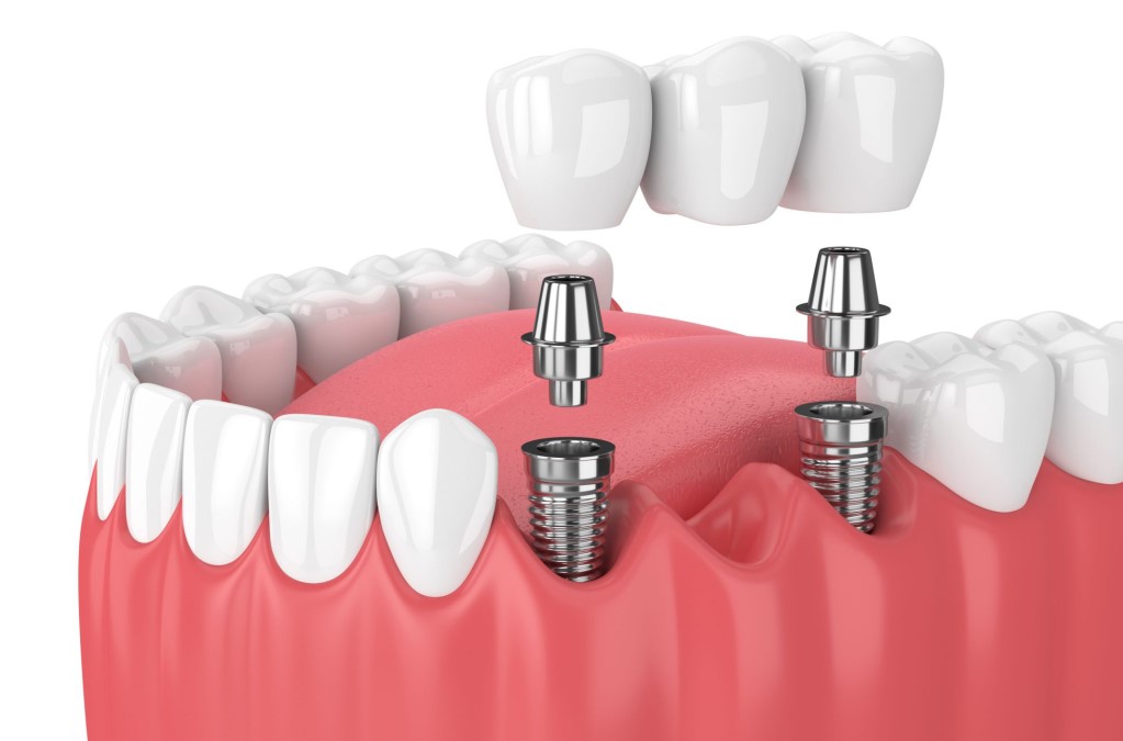 mo-mem-quanh-implant