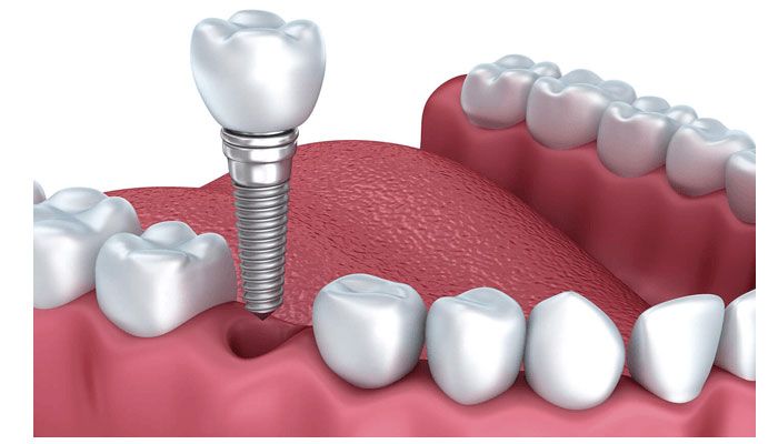 trong-rang-implant