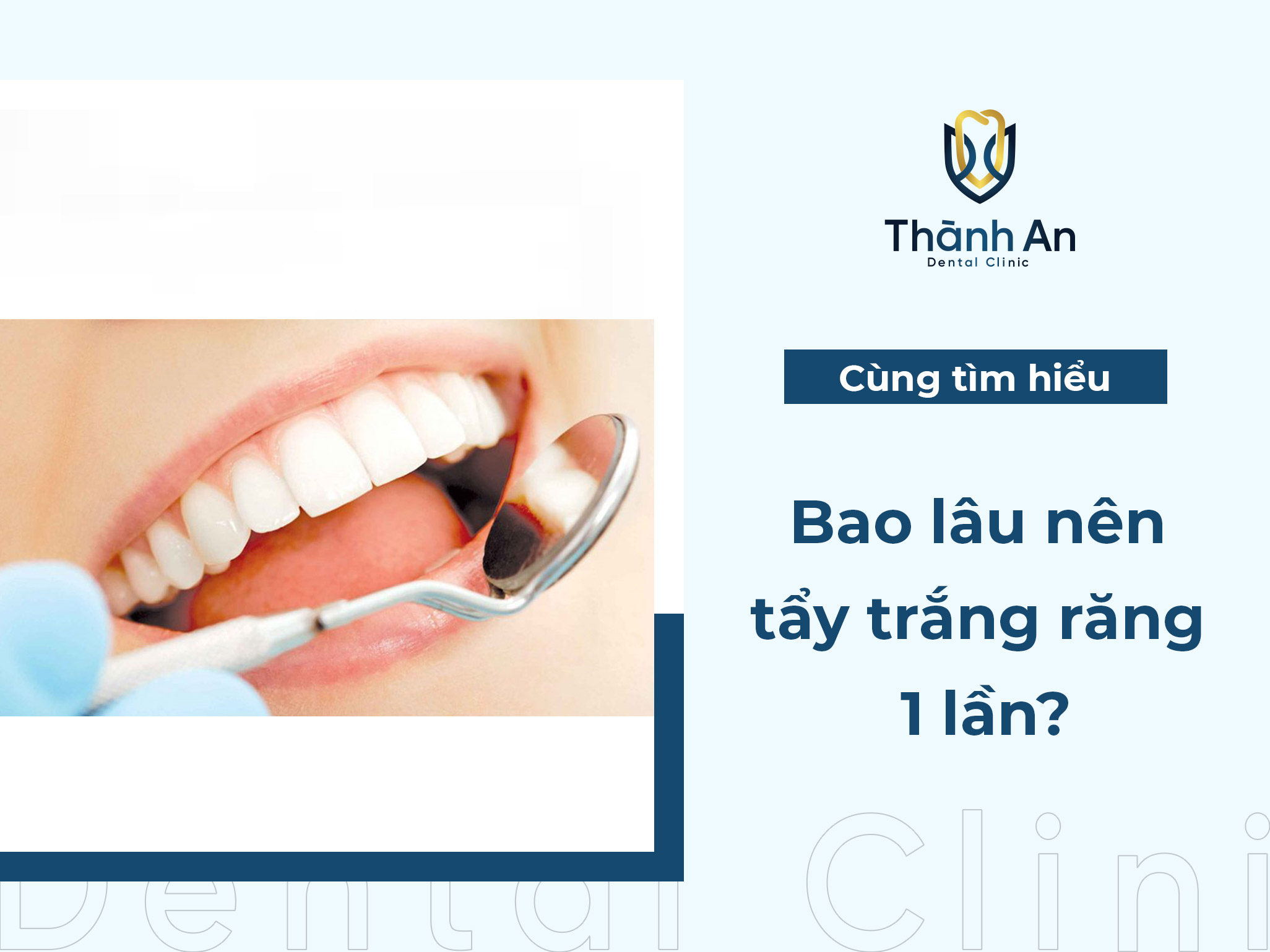 [GIẢI ĐÁP] Bao lâu nên tẩy trắng răng 1 lần?