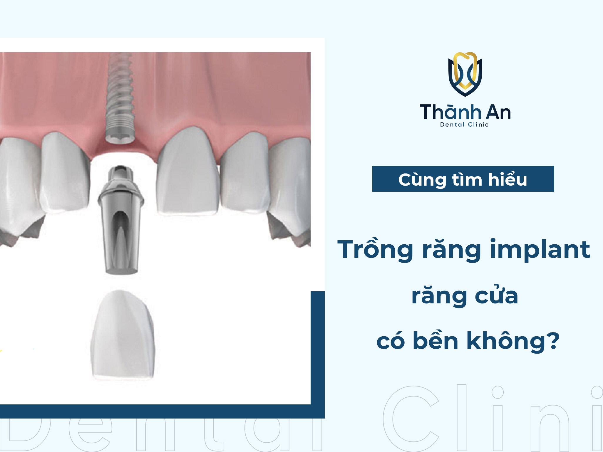 [Hỏi - Đáp] Trồng răng implant răng cửa có bền không?