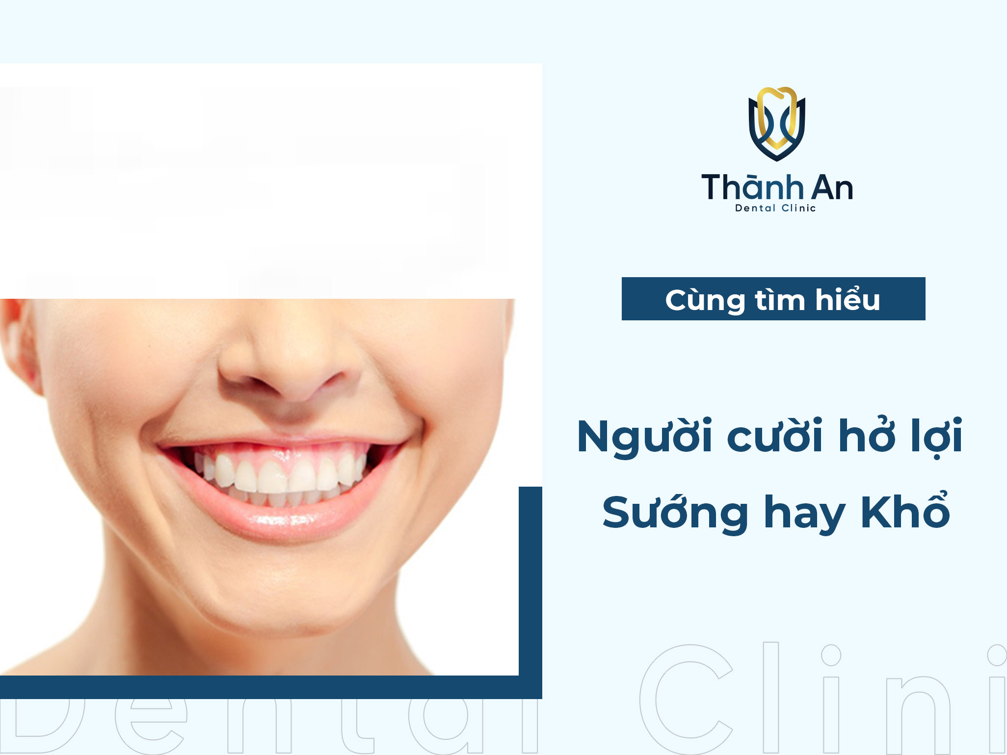 Tướng người cười hở lợi sướng hay khổ? Tốt hay không tốt