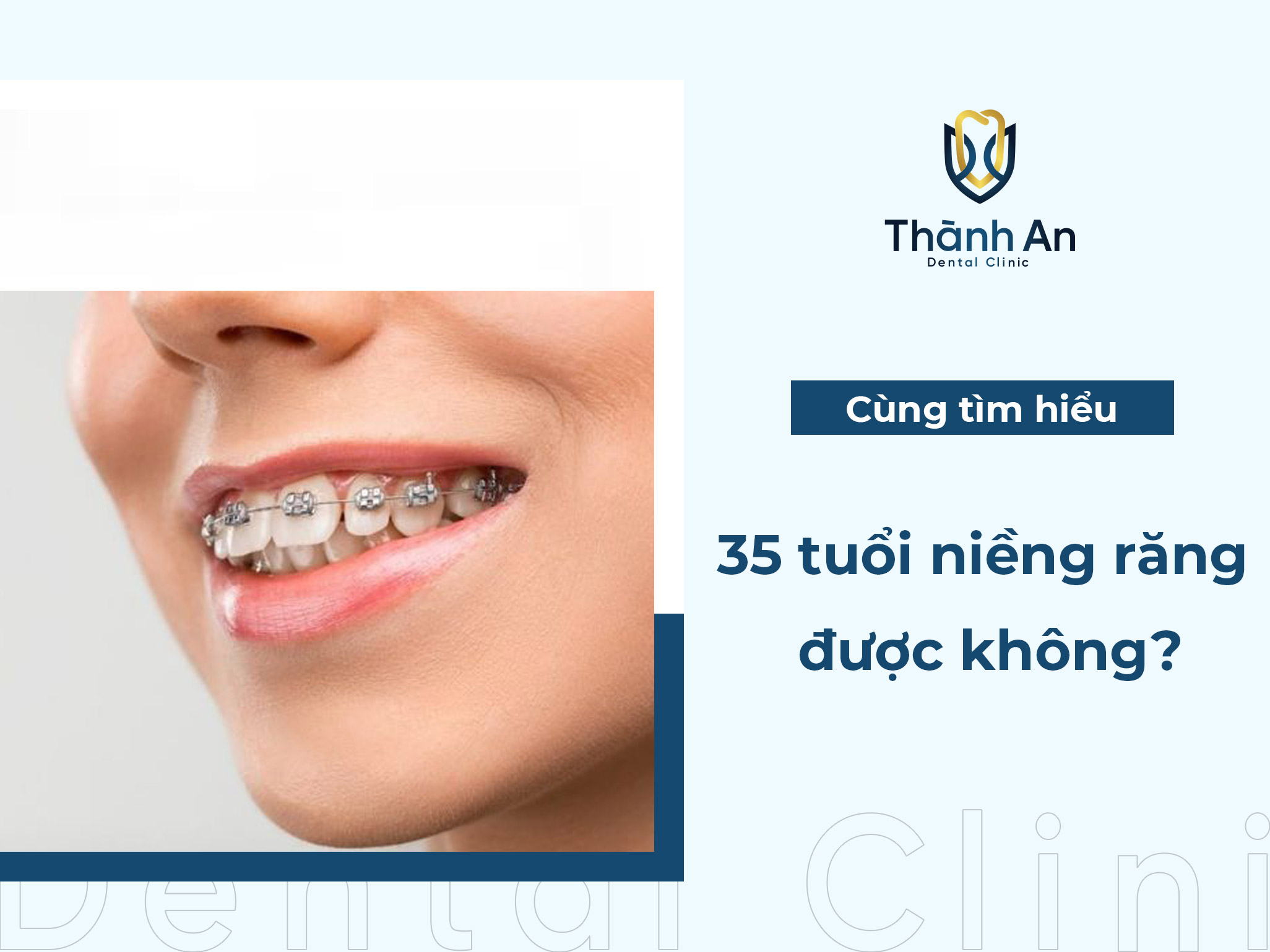 35 tuổi có niềng răng được không giải đáp từ Bác Sĩ Nha Khoa