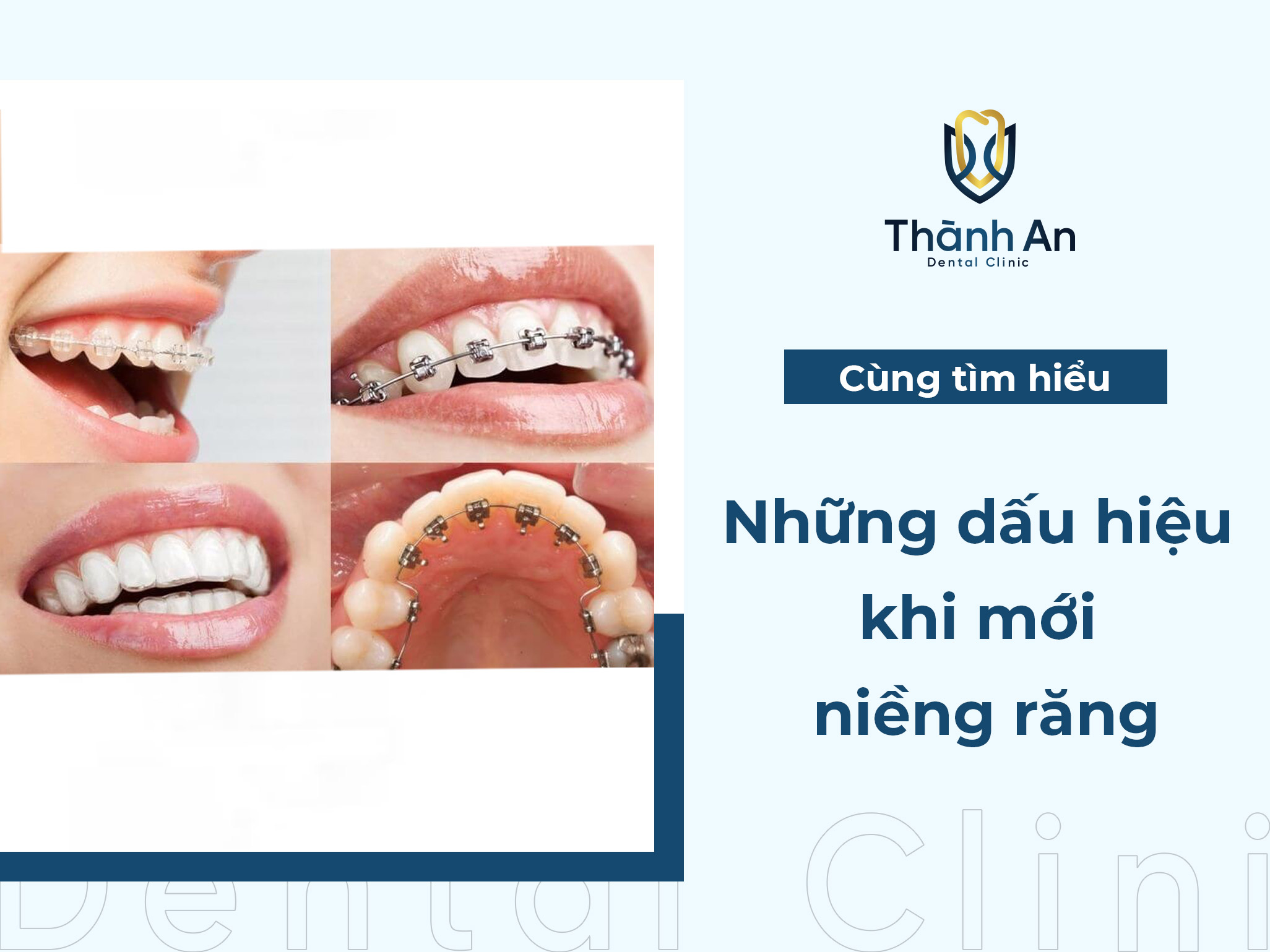 Những dấu hiệu khi mới niềng răng thường gặp và điều đáng lưu ý