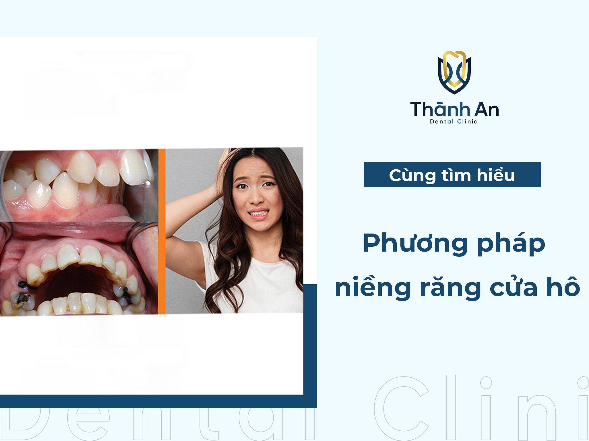 Niềng răng cửa hô: Phương pháp hiệu quả tối ưu thời gian chỉnh nha