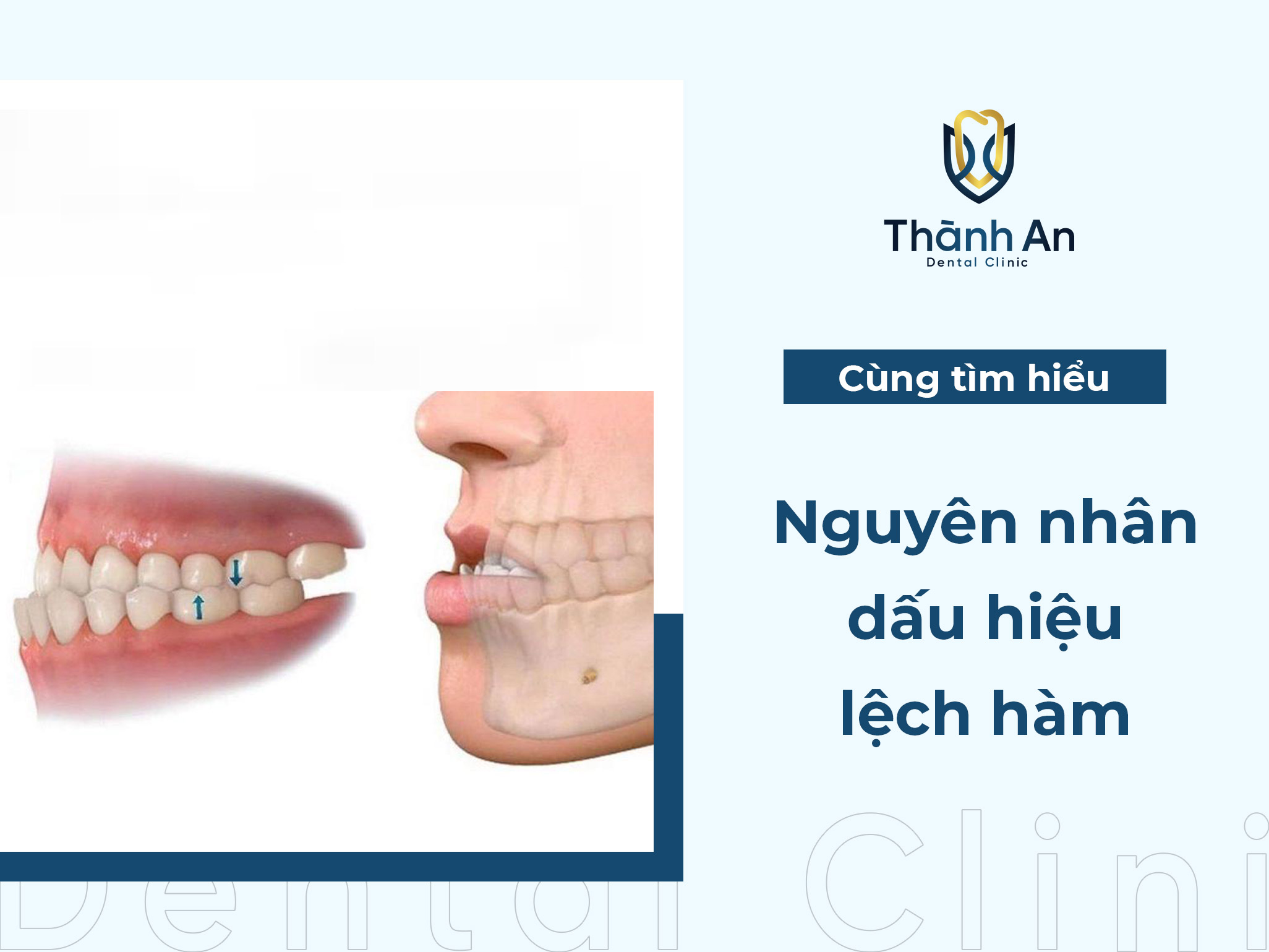 Lệch hàm là gì? Nguyên nhân, dấu hiệu và cách điều trị hiệu quả