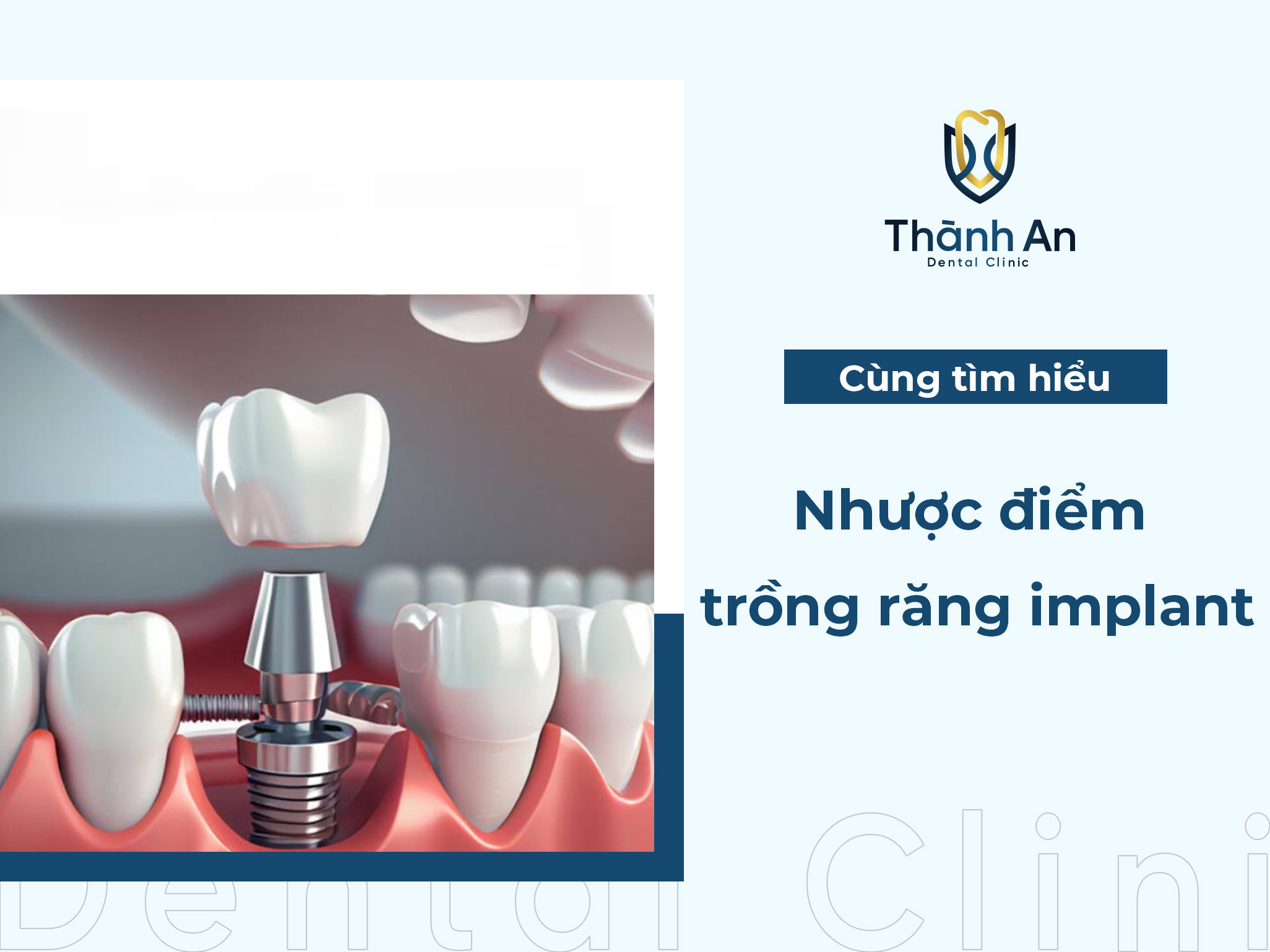 Nhược điểm của trồng răng implant, bạn đã biết 