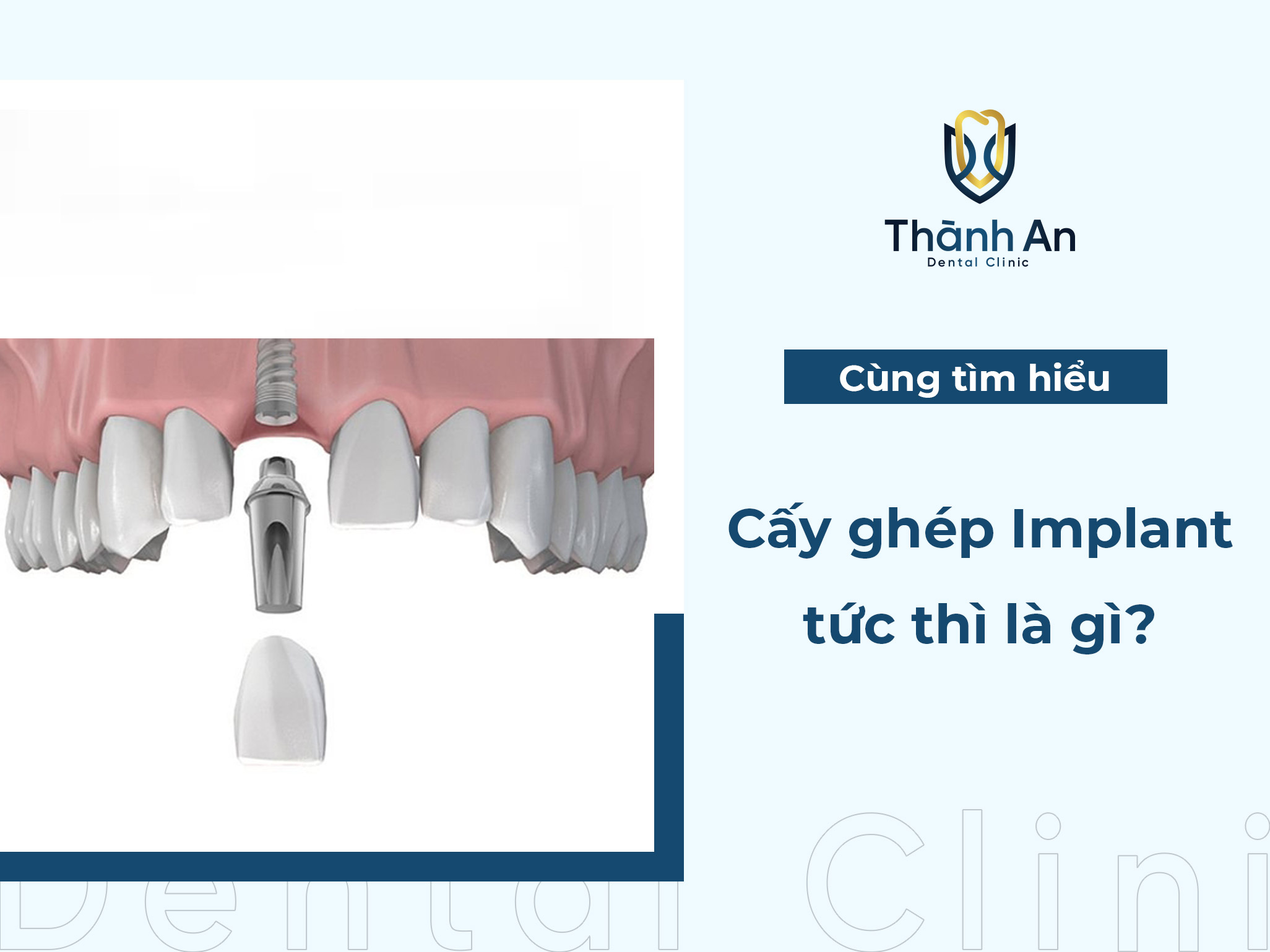 Cấy ghép Implant tức thì là gì? điều kiện và quy trình chi tiết