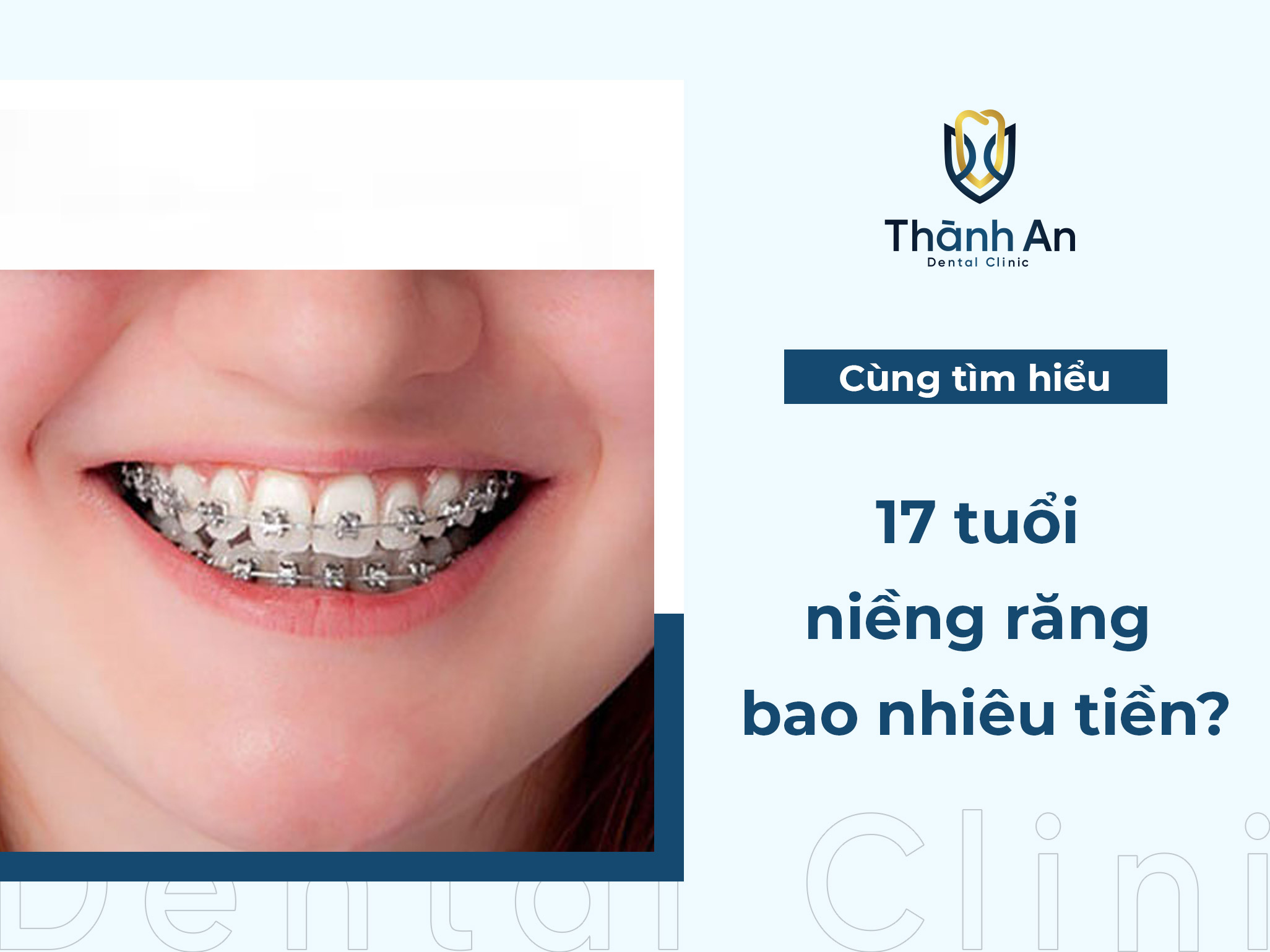 [Giải Đáp] 17 tuổi niềng răng bao nhiêu tiền?