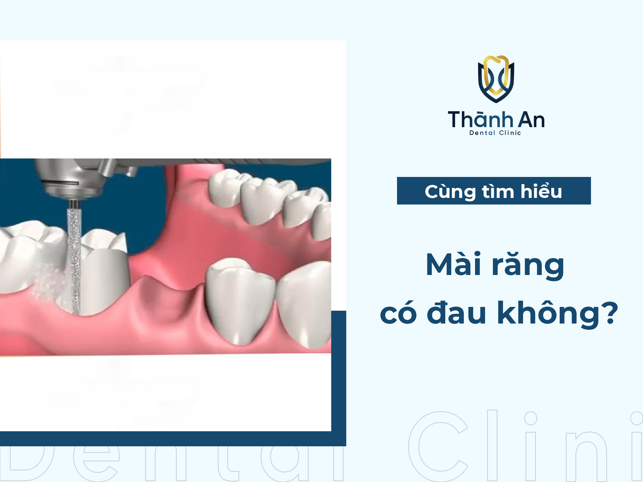 [Hỏi- Đáp] Những ảnh hưởng khi mài răng làm răng sứ