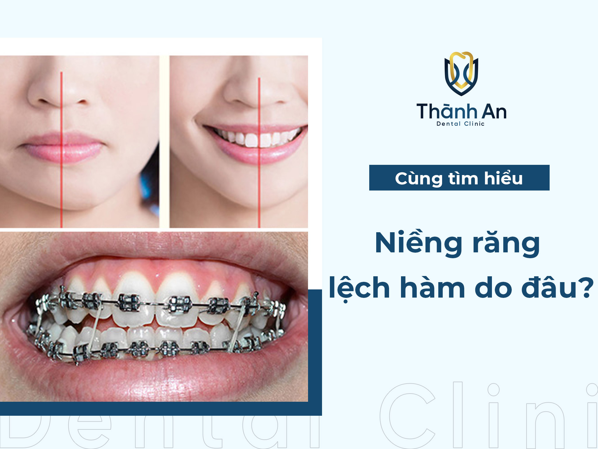Niềng răng lệch hàm do đâu? giải pháp hiệu quả