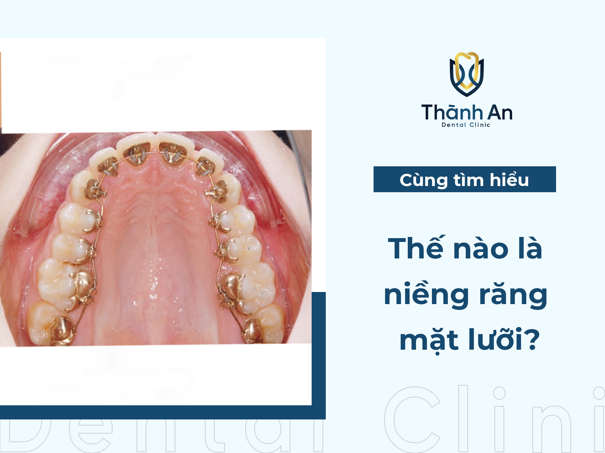 Niềng răng mặt lưỡi là gì? Ưu nhược điểm của niềng mặt lưỡi