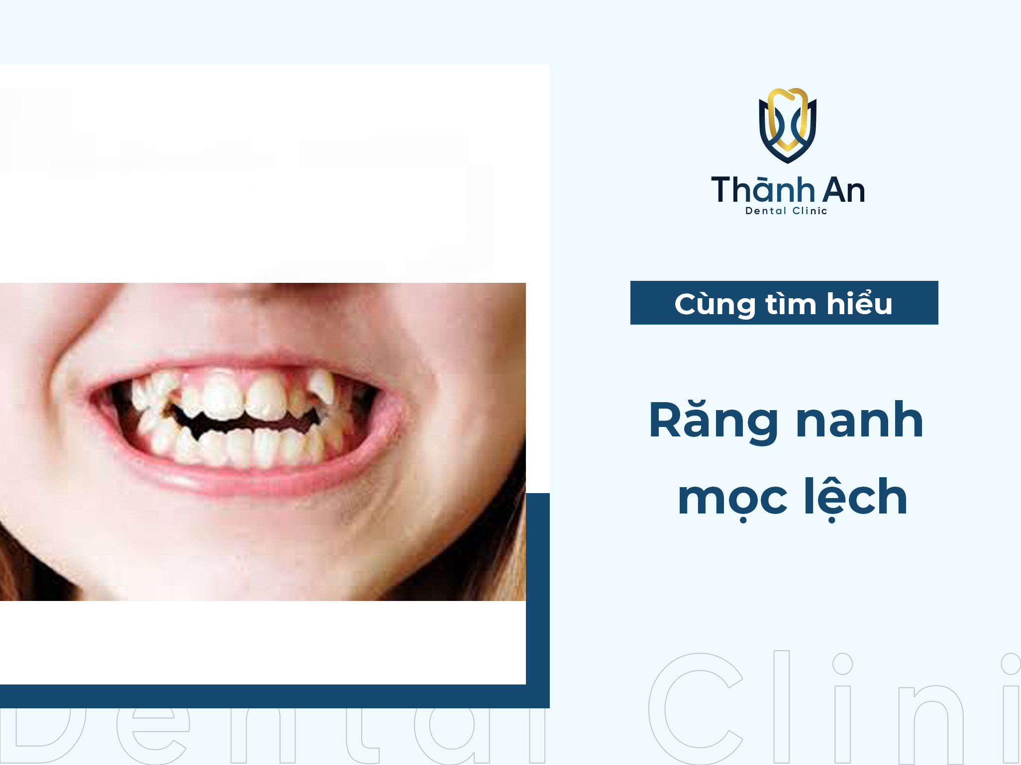 Răng nanh mọc lệch ảnh hưởng đến sức khỏe răng miệng không?