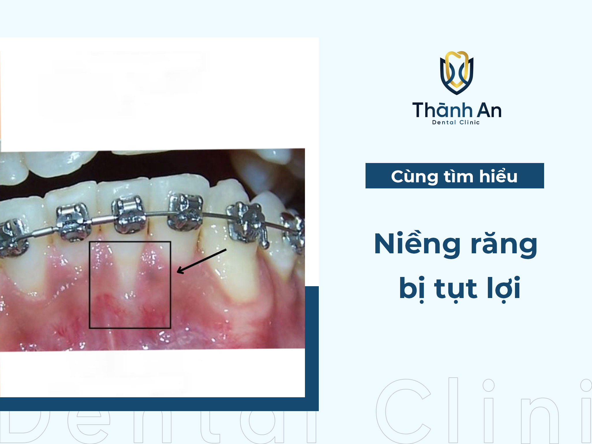 Niềng răng bị tụt lợi: Nguyên nhân, dấu hiệu và cách khắc phục hiệu quả