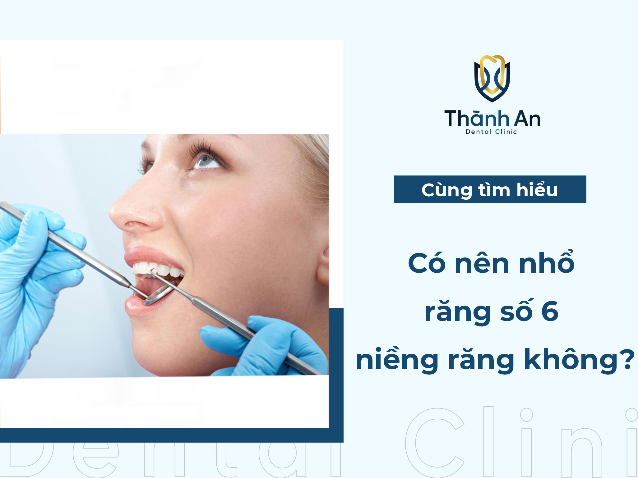 Răng số 6 là gì? Có nên nhổ răng số 6 để niềng răng không?