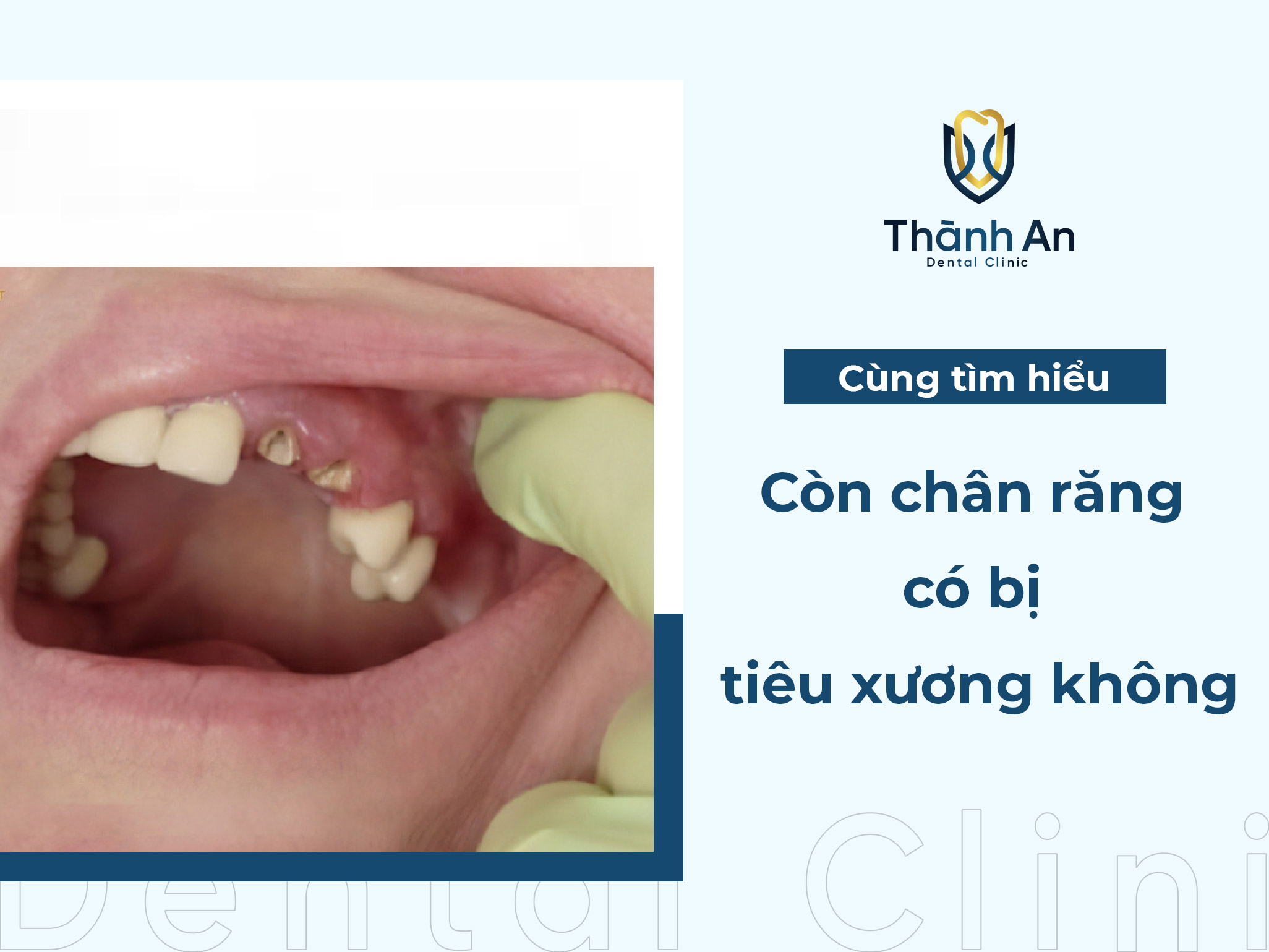 Còn chân răng có bị tiêu xương không? Giải đáp từ CHUYÊN GIA