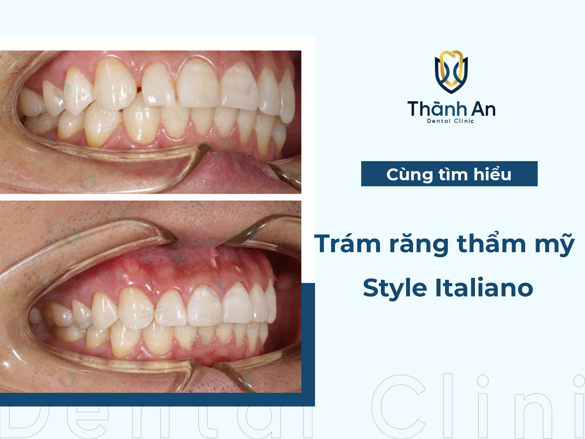 Trám răng thẩm mỹ Style Italiano phục hồi tình trạng răng thưa sứt mẻ HIỆU QUẢ