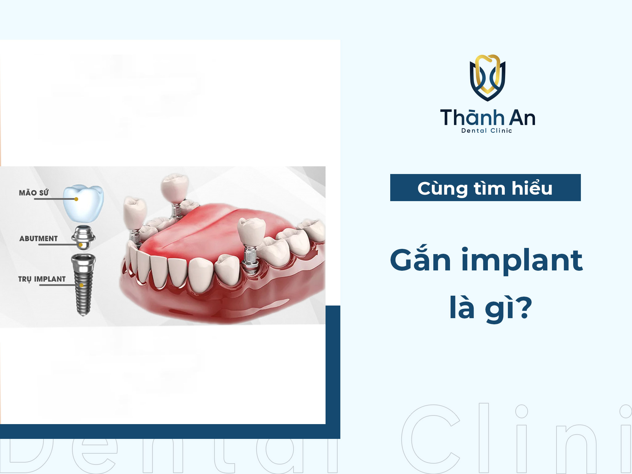 Gắn implant là gì? Tại sao cần gắn implant?