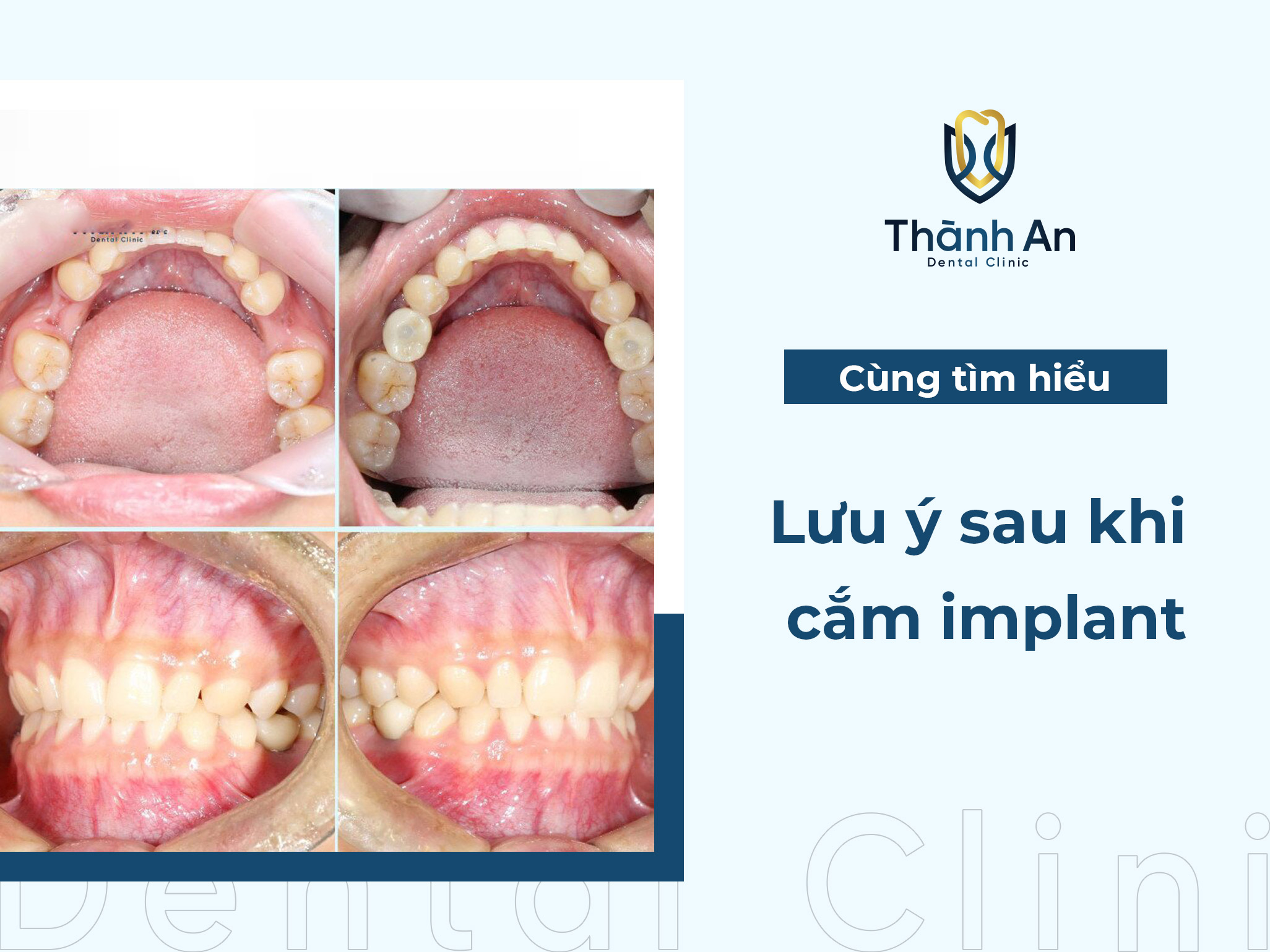 Lưu ý sau khi cắm implant: Tránh biến chứng nguy hiểm!