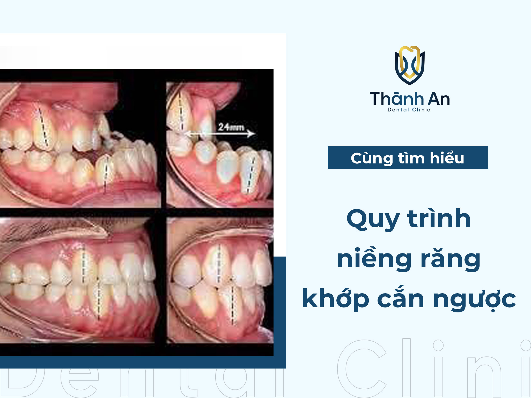 5 bước trong quy trình niềng răng khớp cắn ngược, bạn đã biết