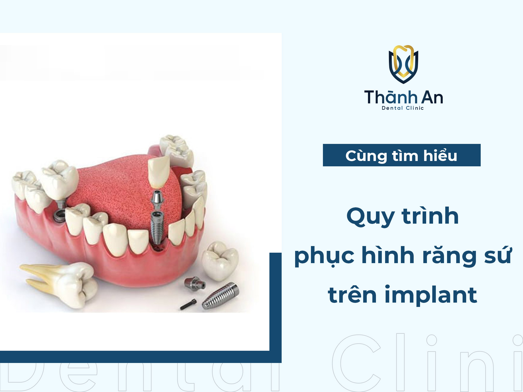 Phục hình răng sứ trên implant và quy trình thực hiện mới nhất