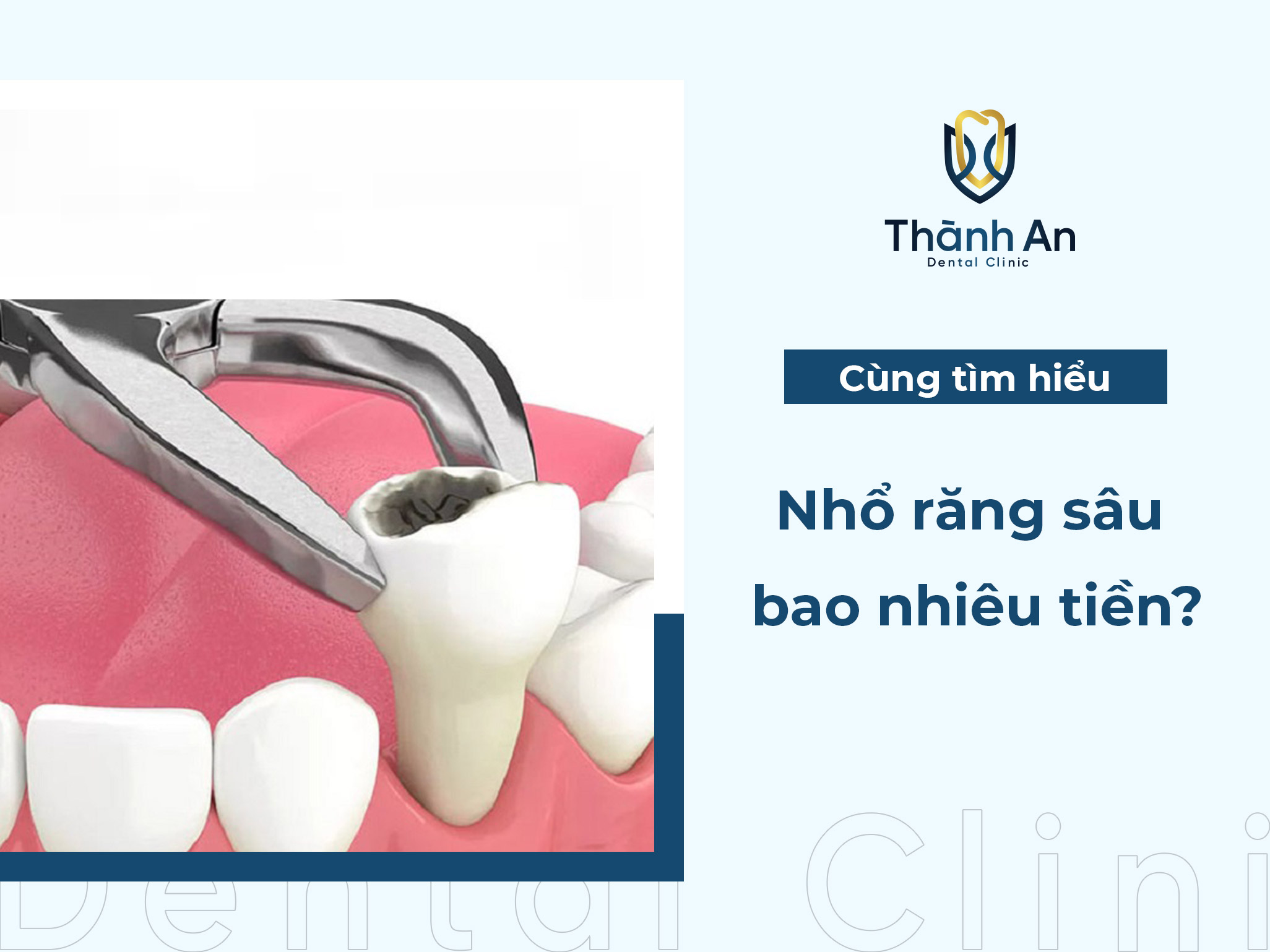 Nhổ răng sâu bao nhiêu tiền? Giá nhổ từng trường hợp