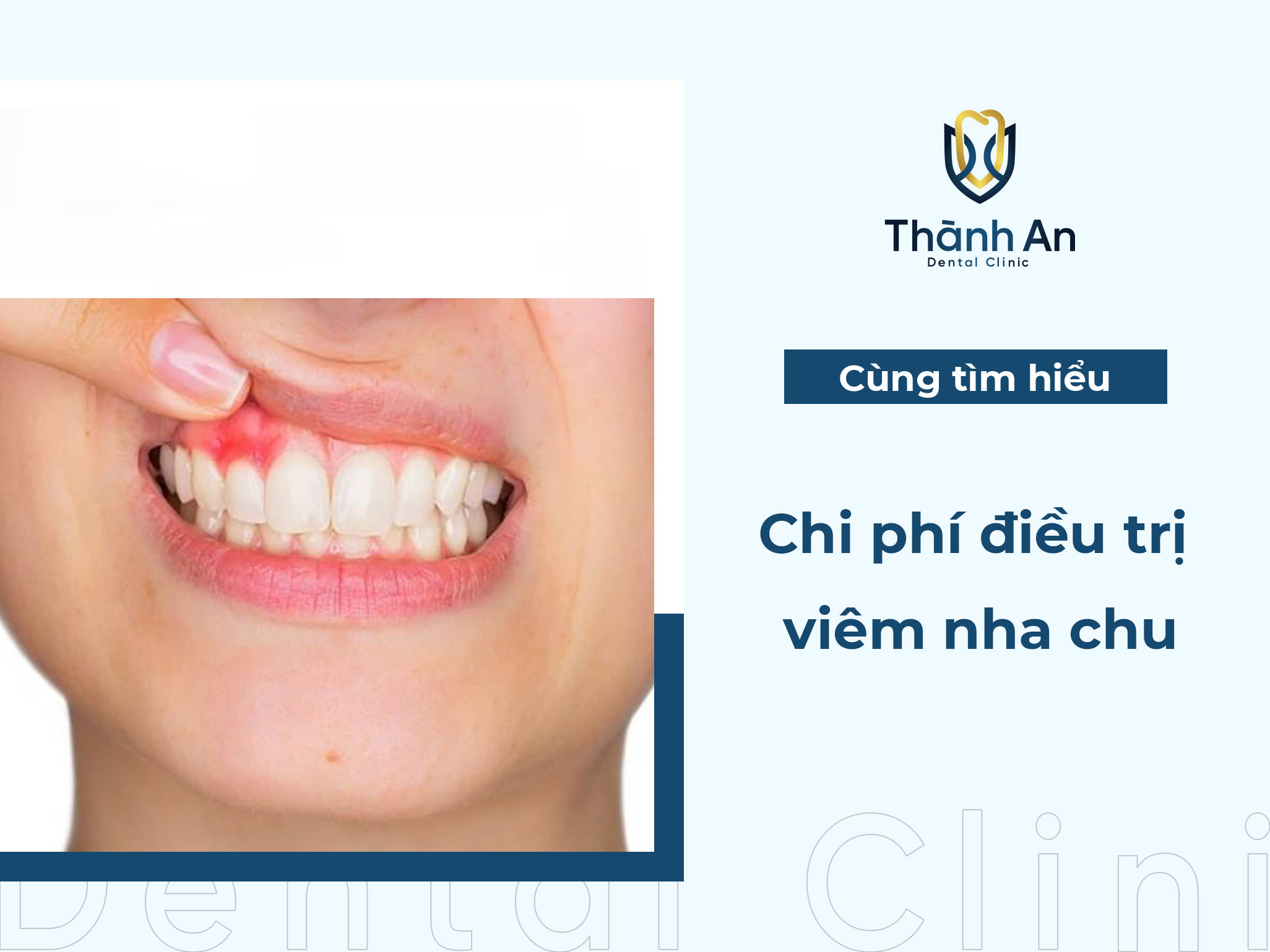 Chi phí điều trị viêm nha chu - cập nhất mới nhất 2024