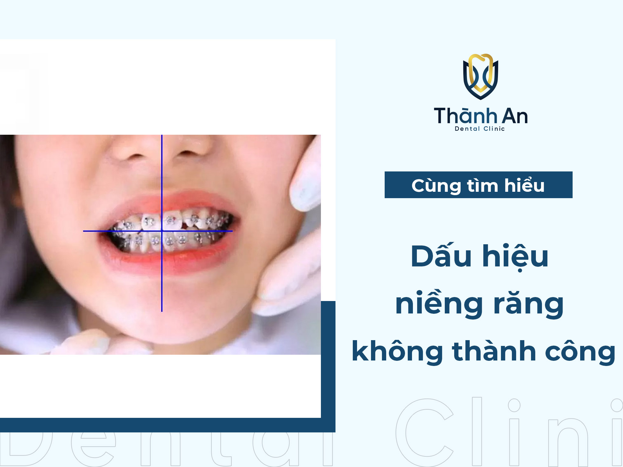 Dấu hiệu niềng răng không thành công – Giải pháp khắc phục