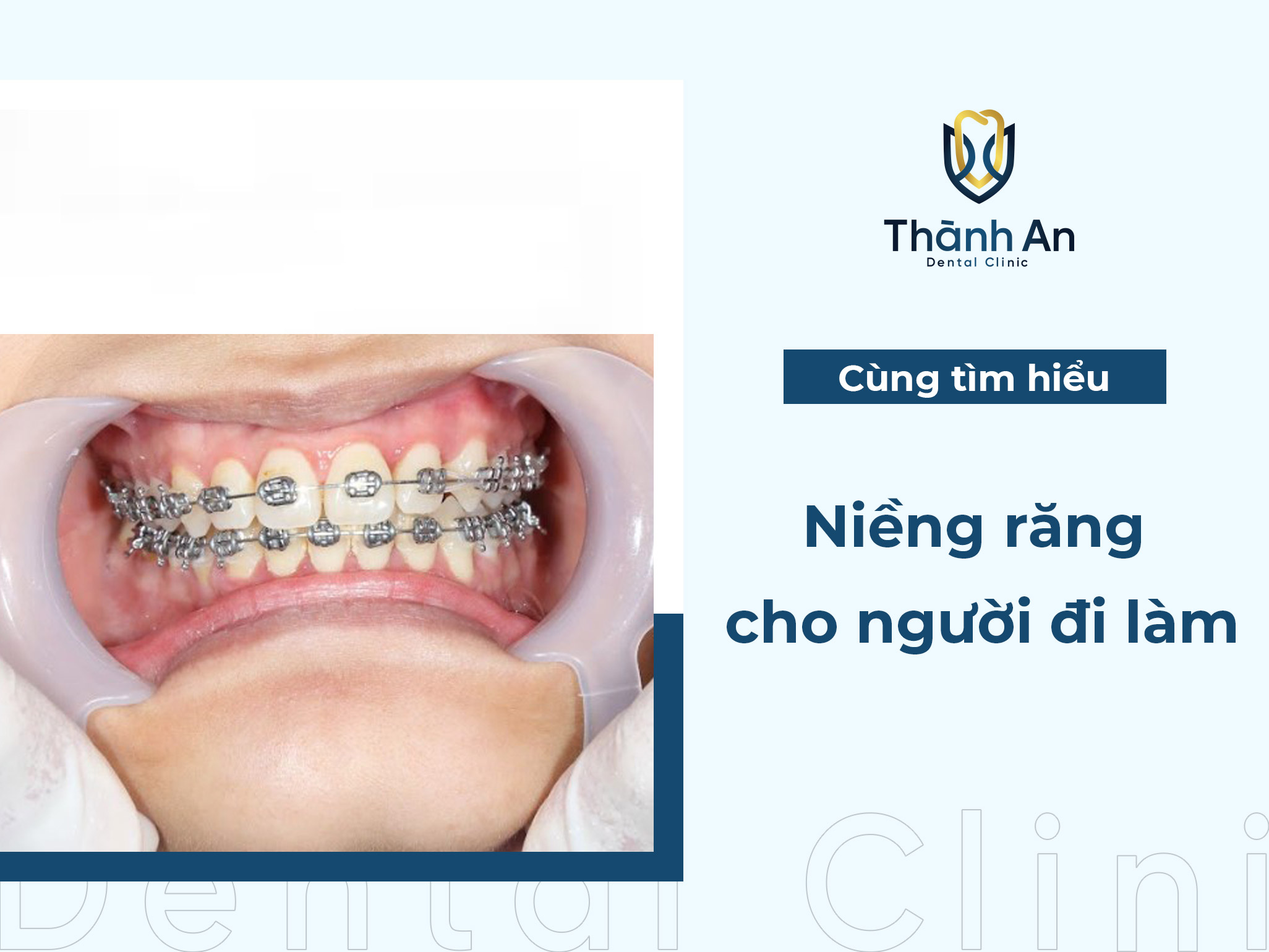 Niềng răng cho người đi làm nên chọn phương pháp nào?