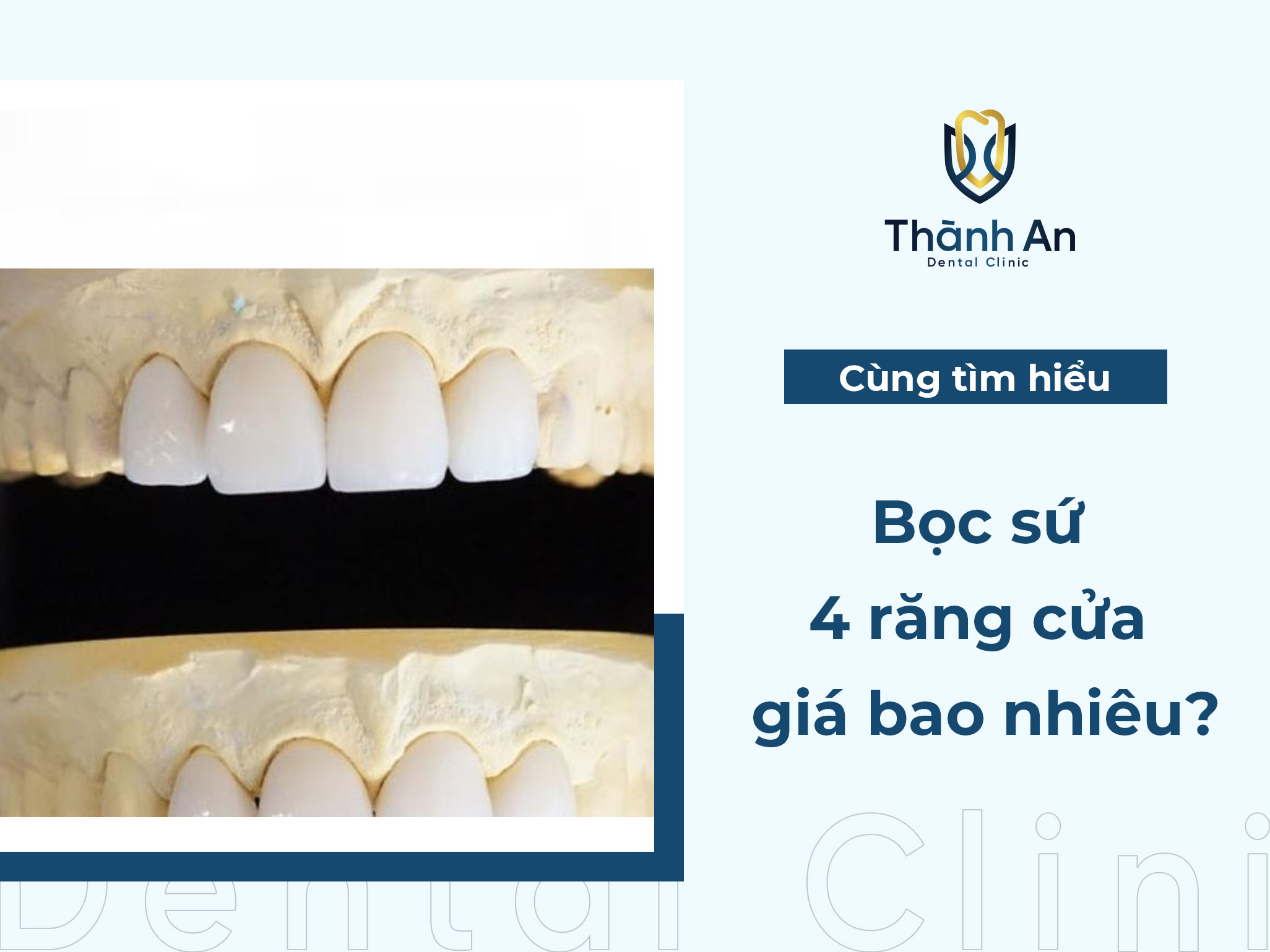 Bọc sứ 4 răng cửa giá bao nhiêu? Nên chọn loại nào thích hợp?