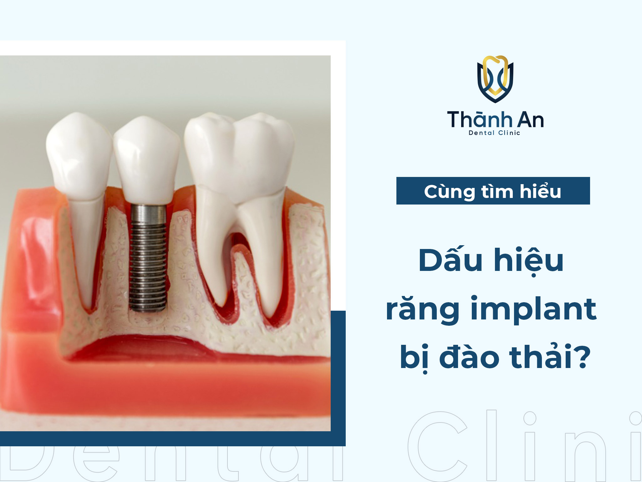 Răng implant bị đào thải: Dấu hiệu nhận biết và cách xử lý