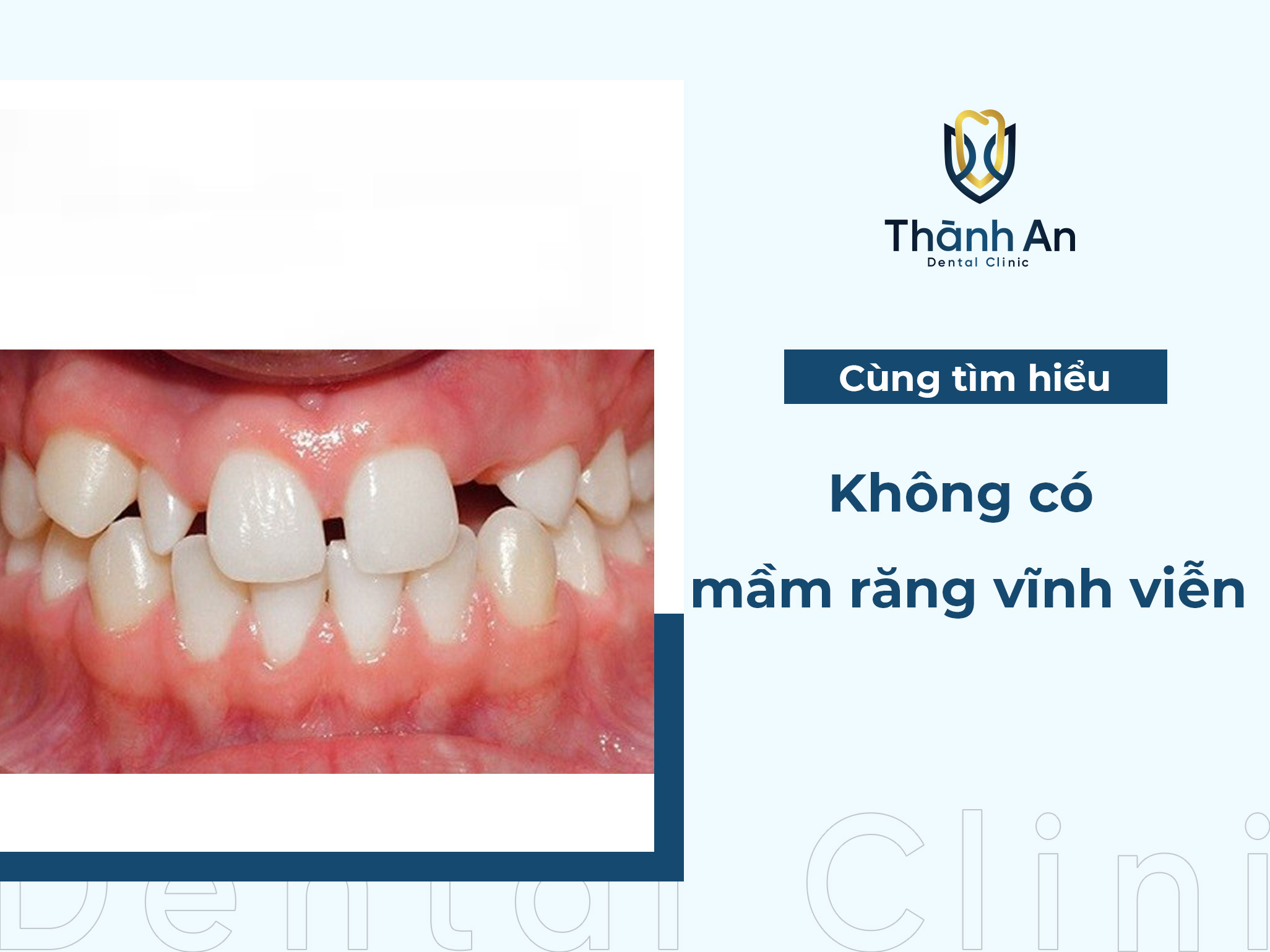 Không có mầm răng vĩnh viễn có nguy hiểm không?