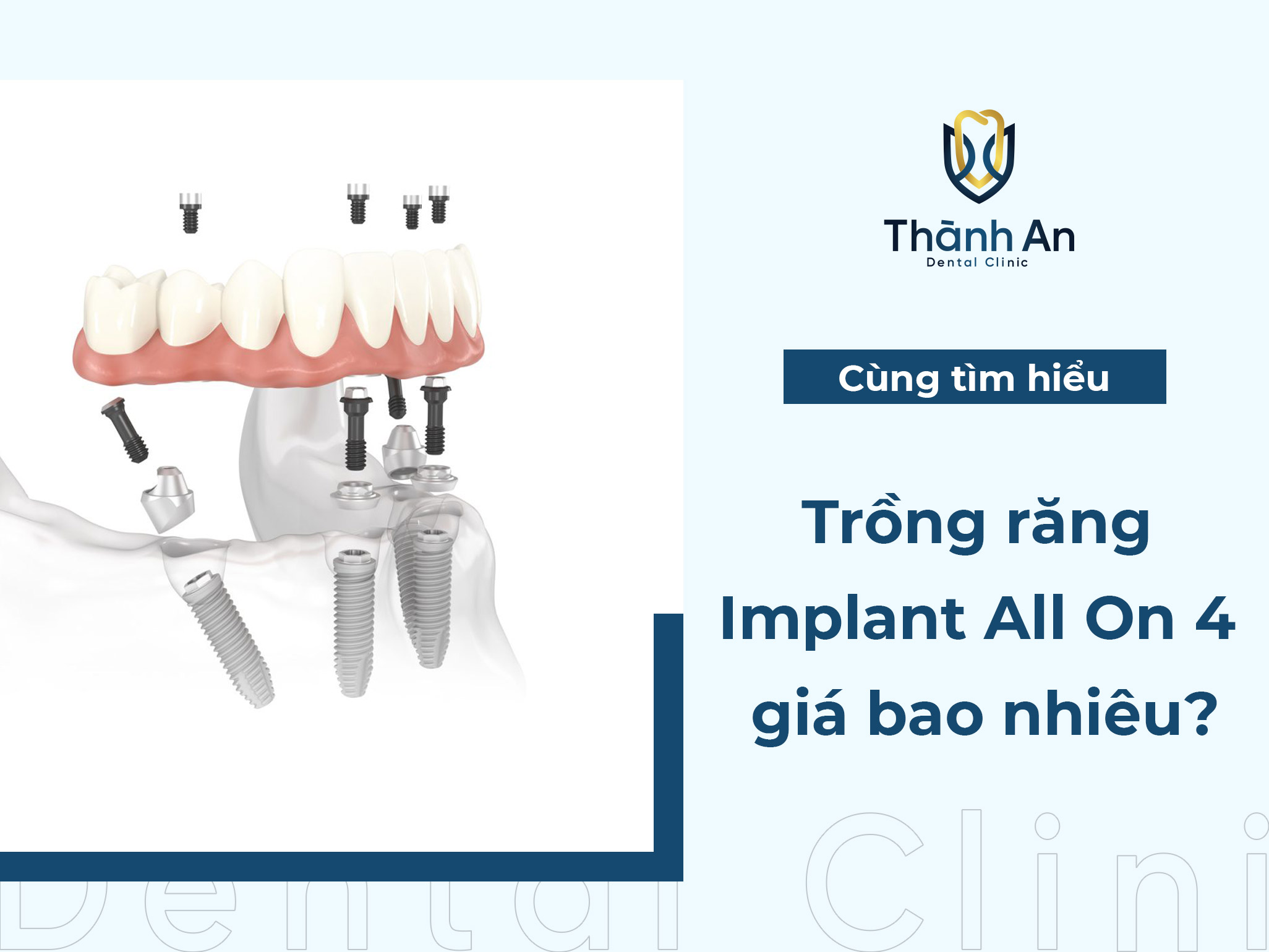 [Hỏi - Đáp] Trồng răng implant all on 4 giá bao nhiêu?